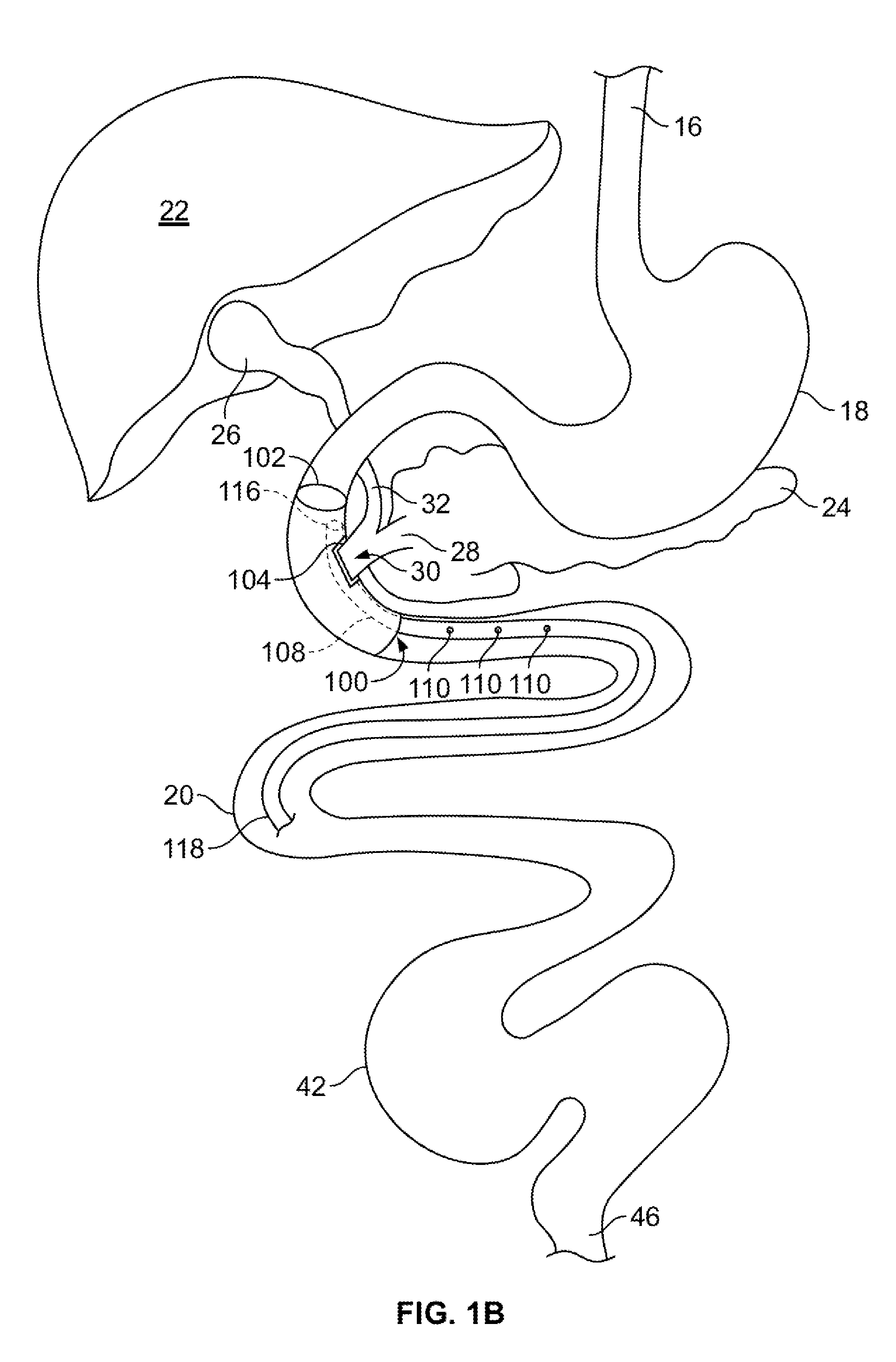 Gastrointestinal implant and methods for use