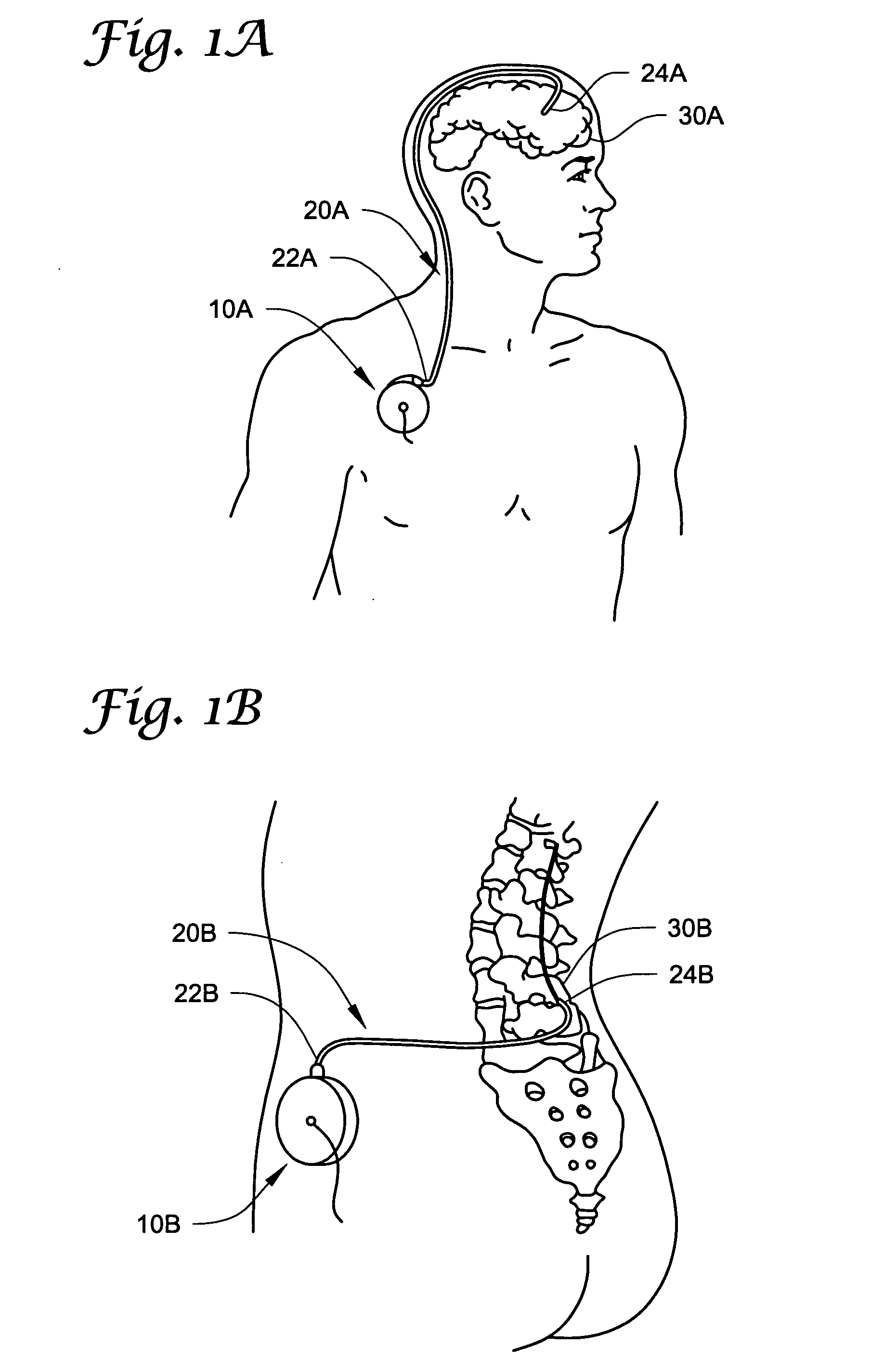 Catheters with tracking elements and permeable membranes