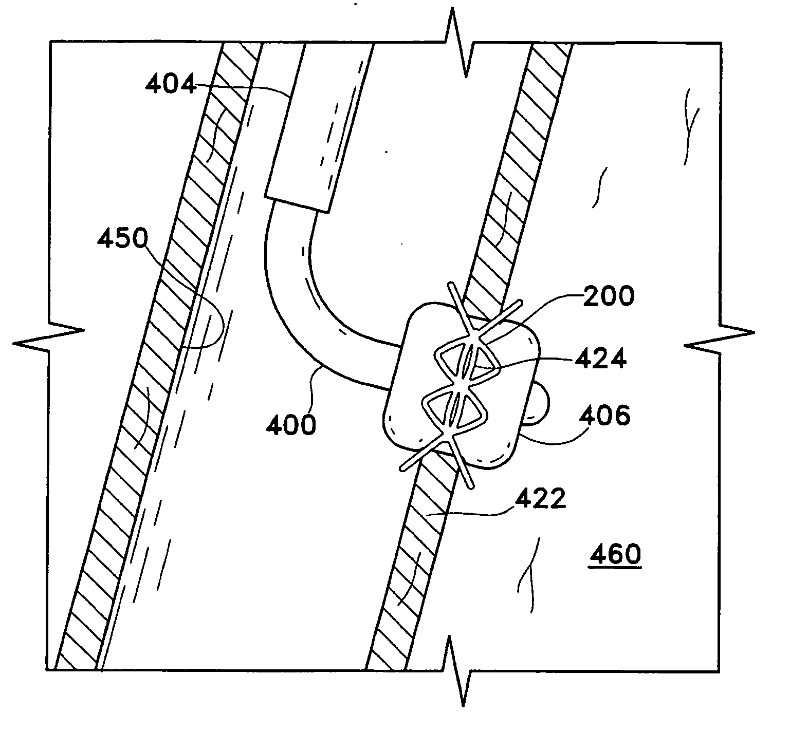 Devices for maintaining patency of surgically created channels in tissue