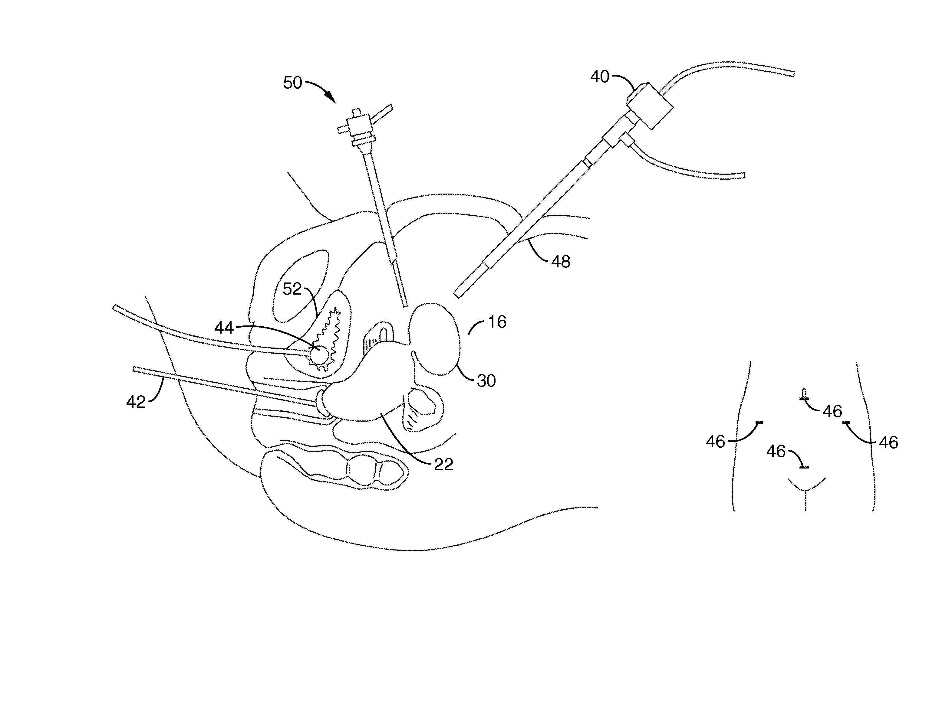 Method of thermal treatment of myolysis and destruction of benign uterine tumors