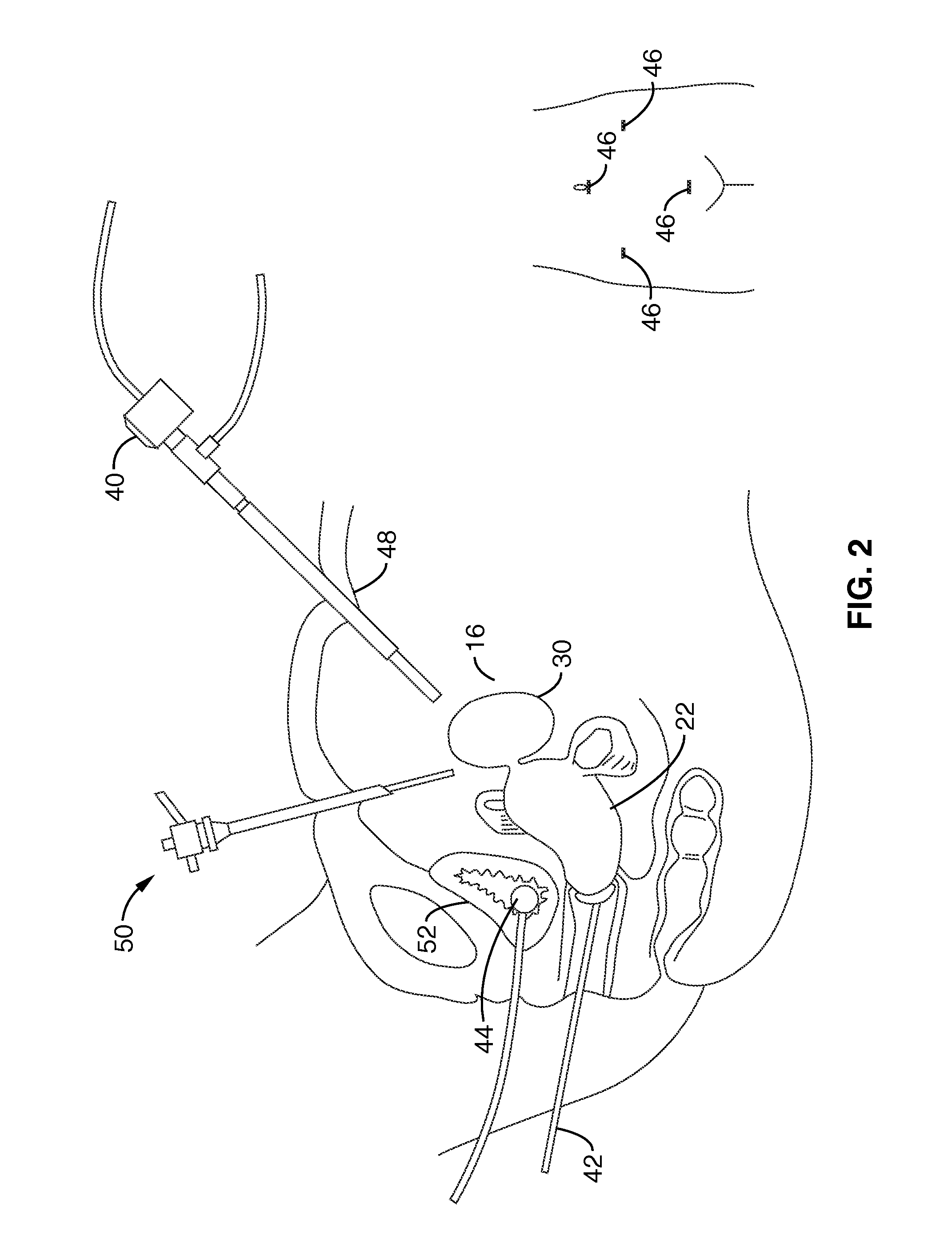 Method of thermal treatment of myolysis and destruction of benign uterine tumors