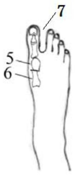 A fixation device after distal metatarsal osteotomy