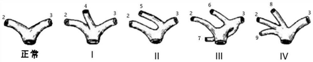 Typing method based on intelligent hepatic portal vein