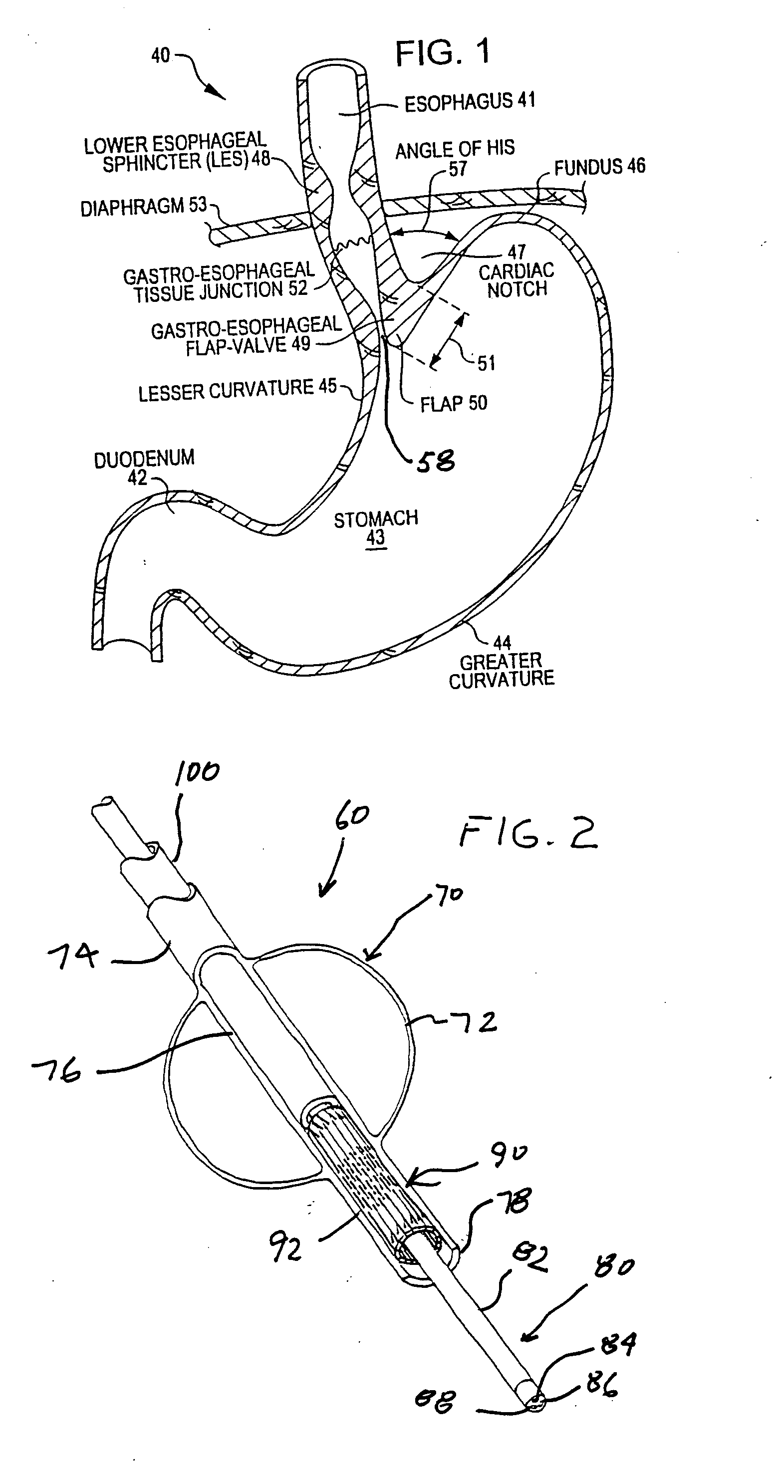 Transesophageal gastric reduction device, system and method