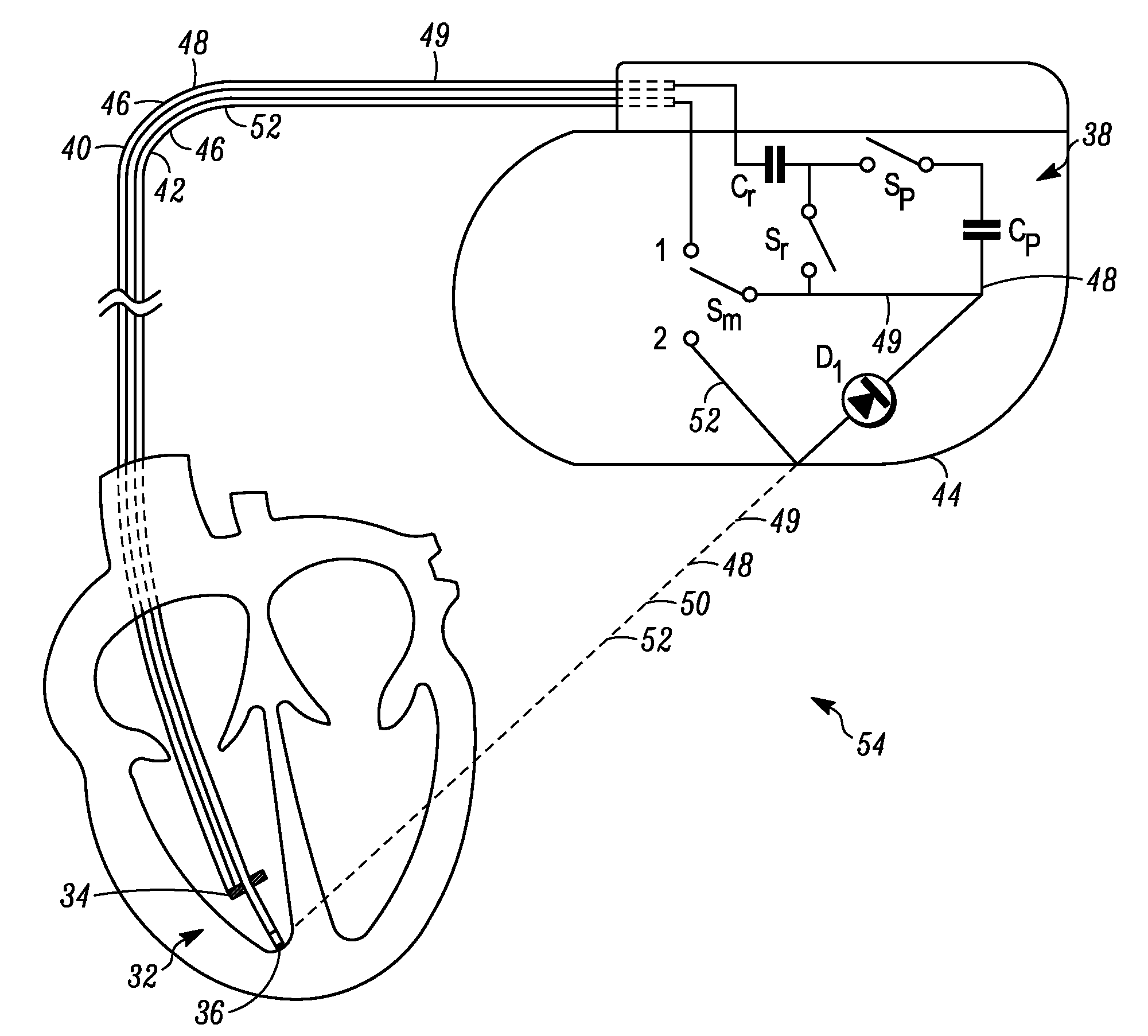 MRI Compatible Implantable Medical Devices and Methods