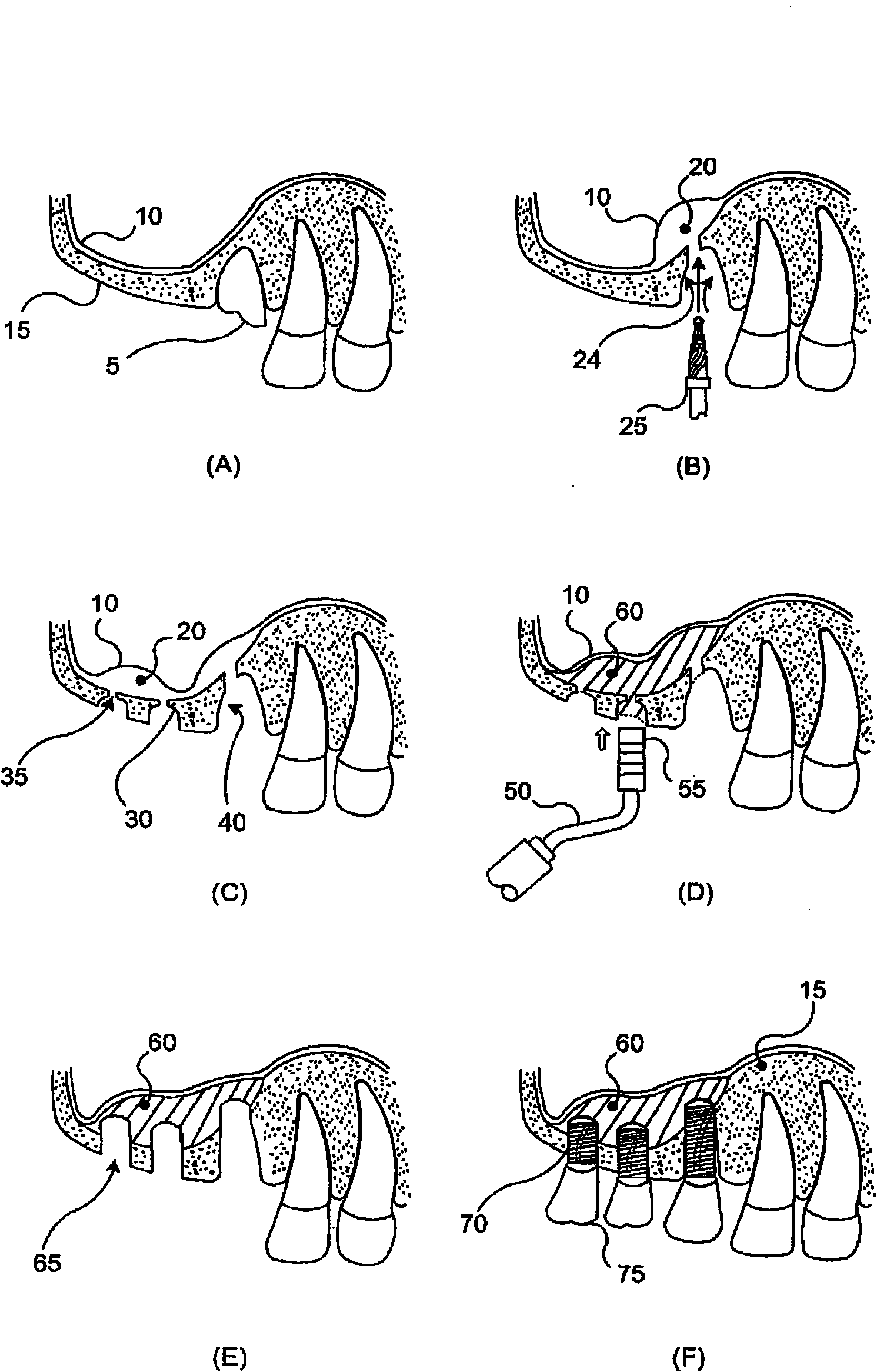 Dental implant method