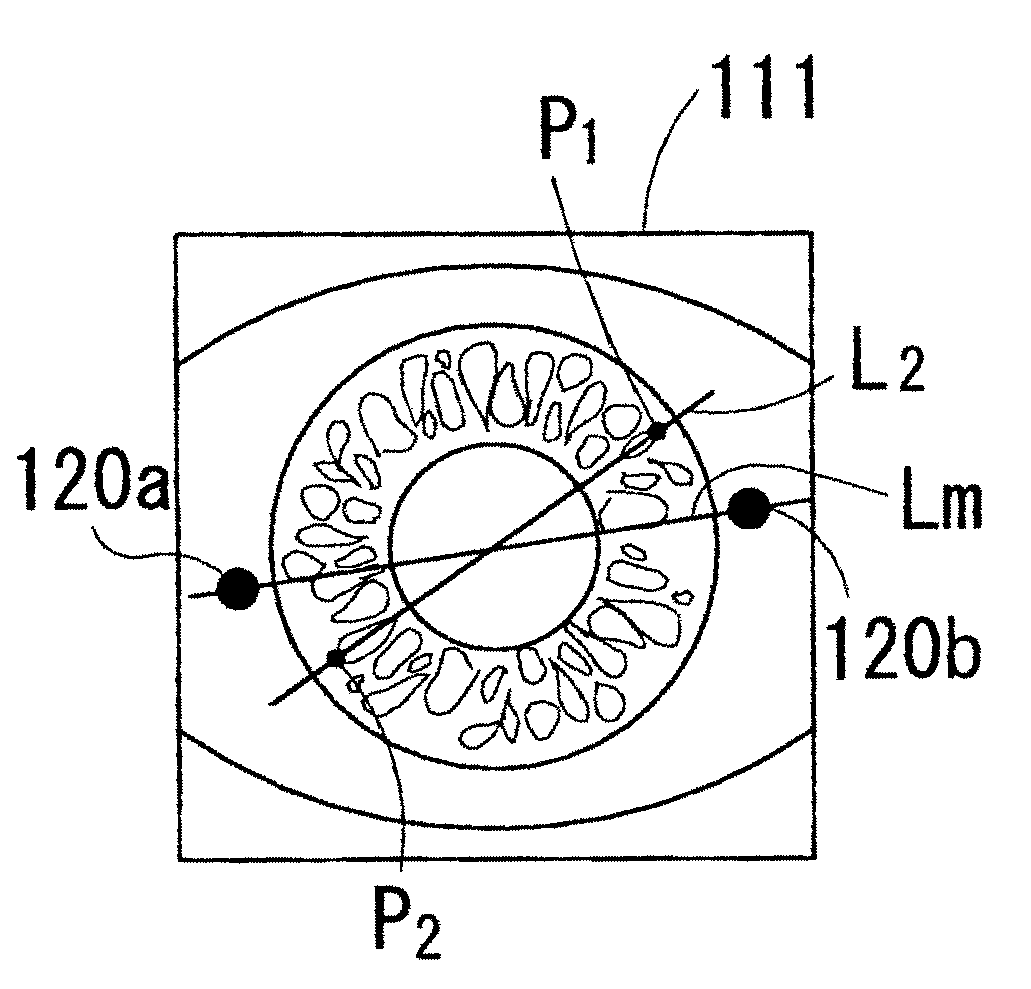 Corneal surgery apparatus