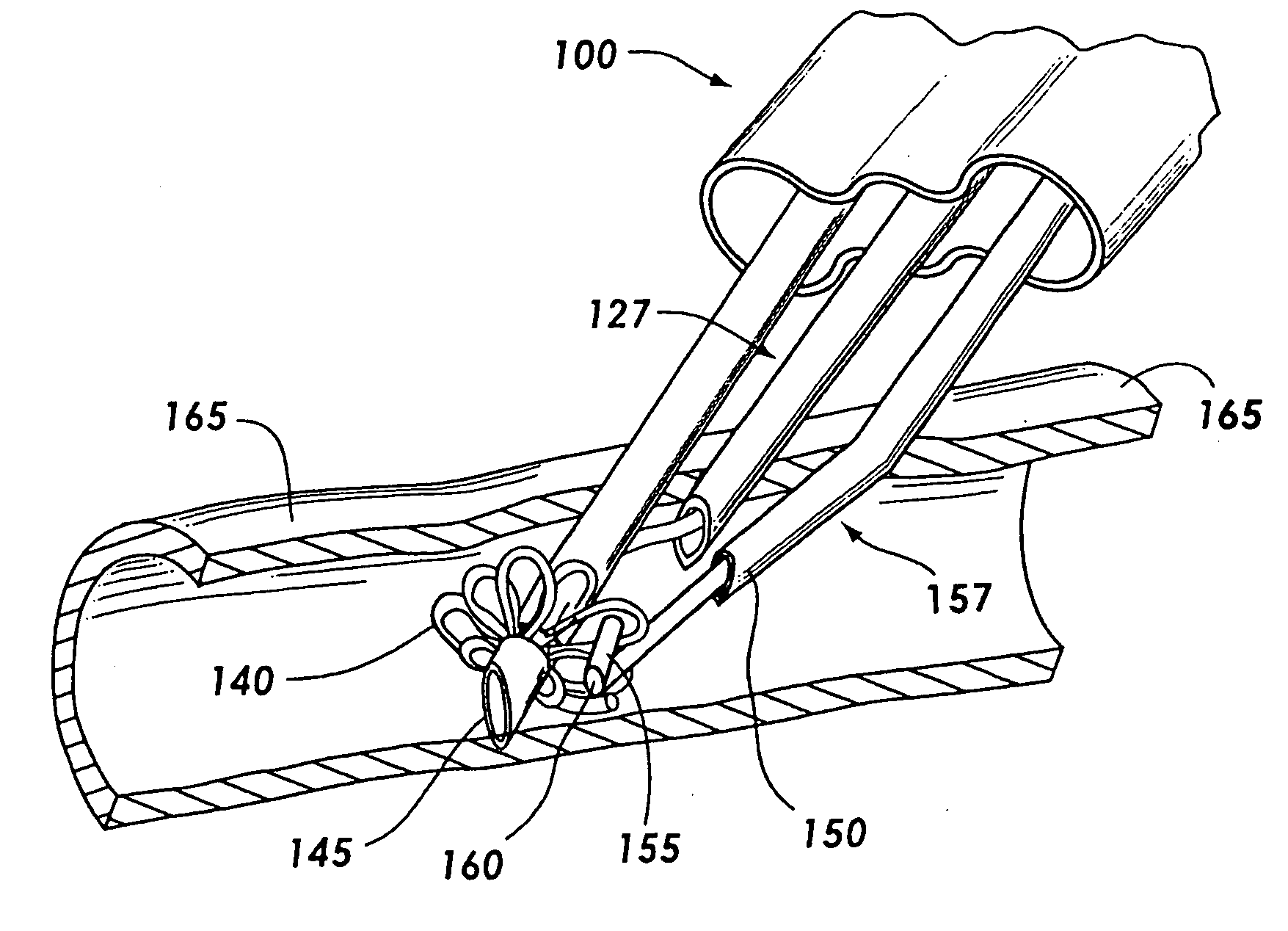 Three-needle closure device