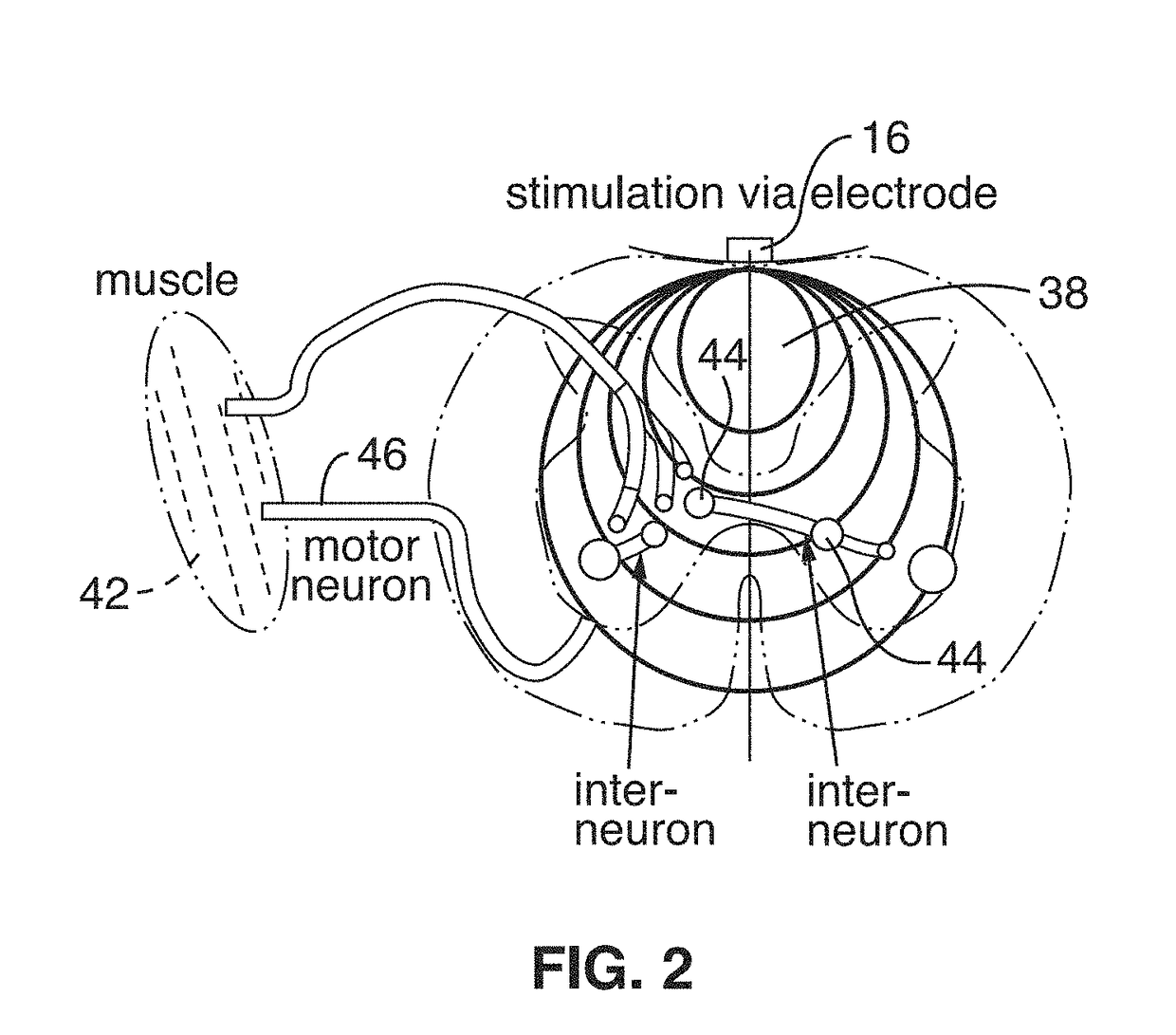 Wireless implant for motor function recovery after spinal cord injury