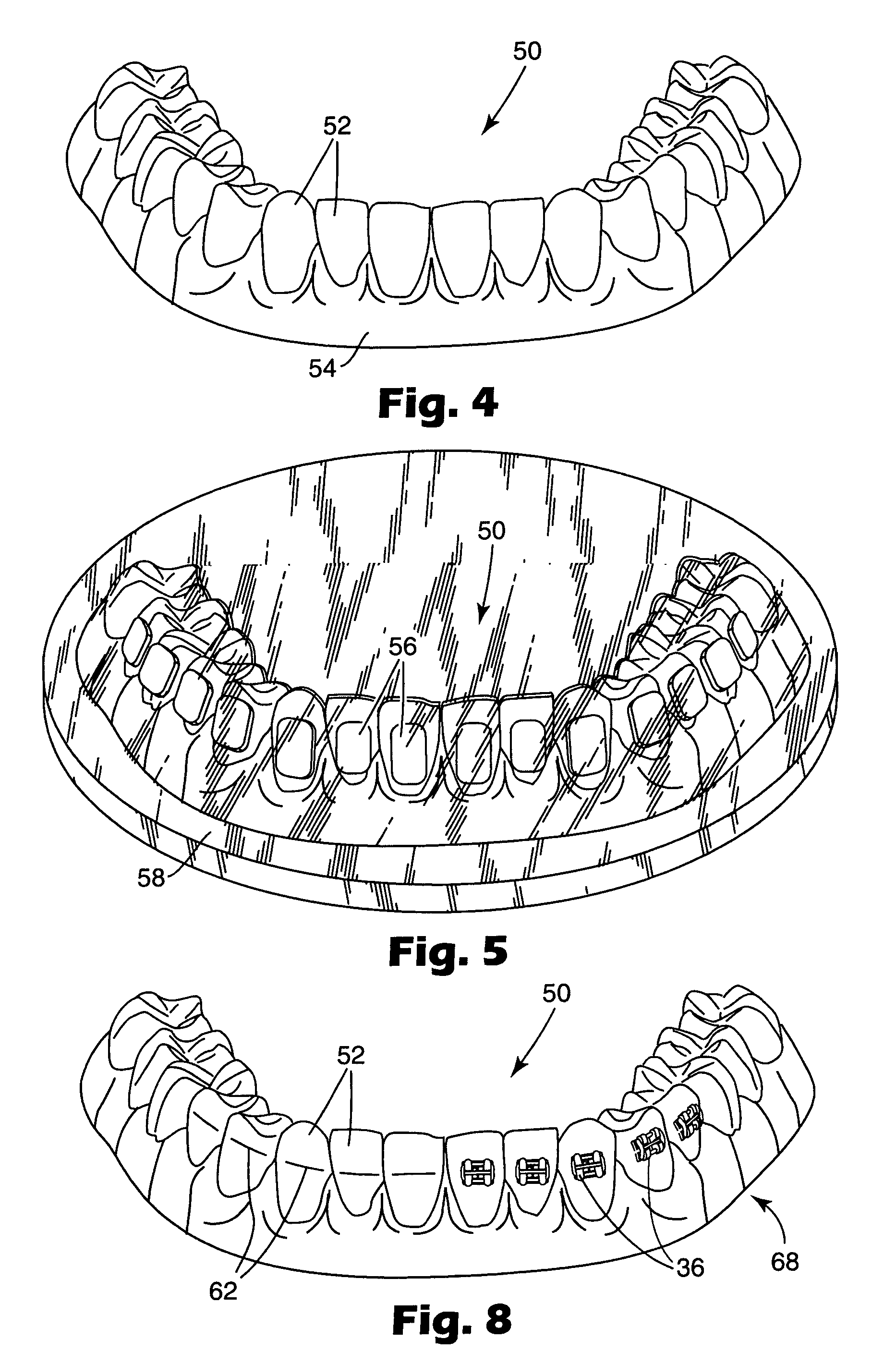 Apparatus for indirect bonding of orthodontic appliances and method of making the same