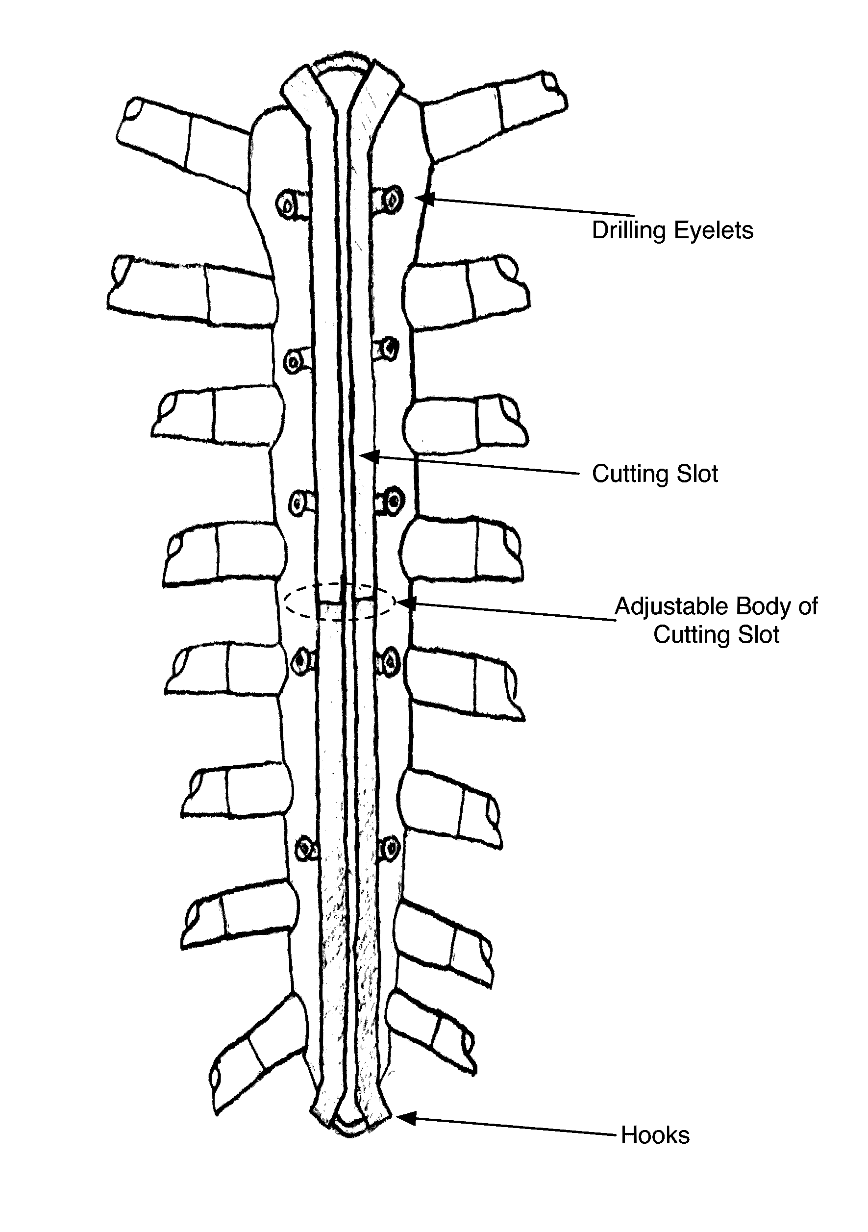 Sternal osteotomy guide and sternal fixation system