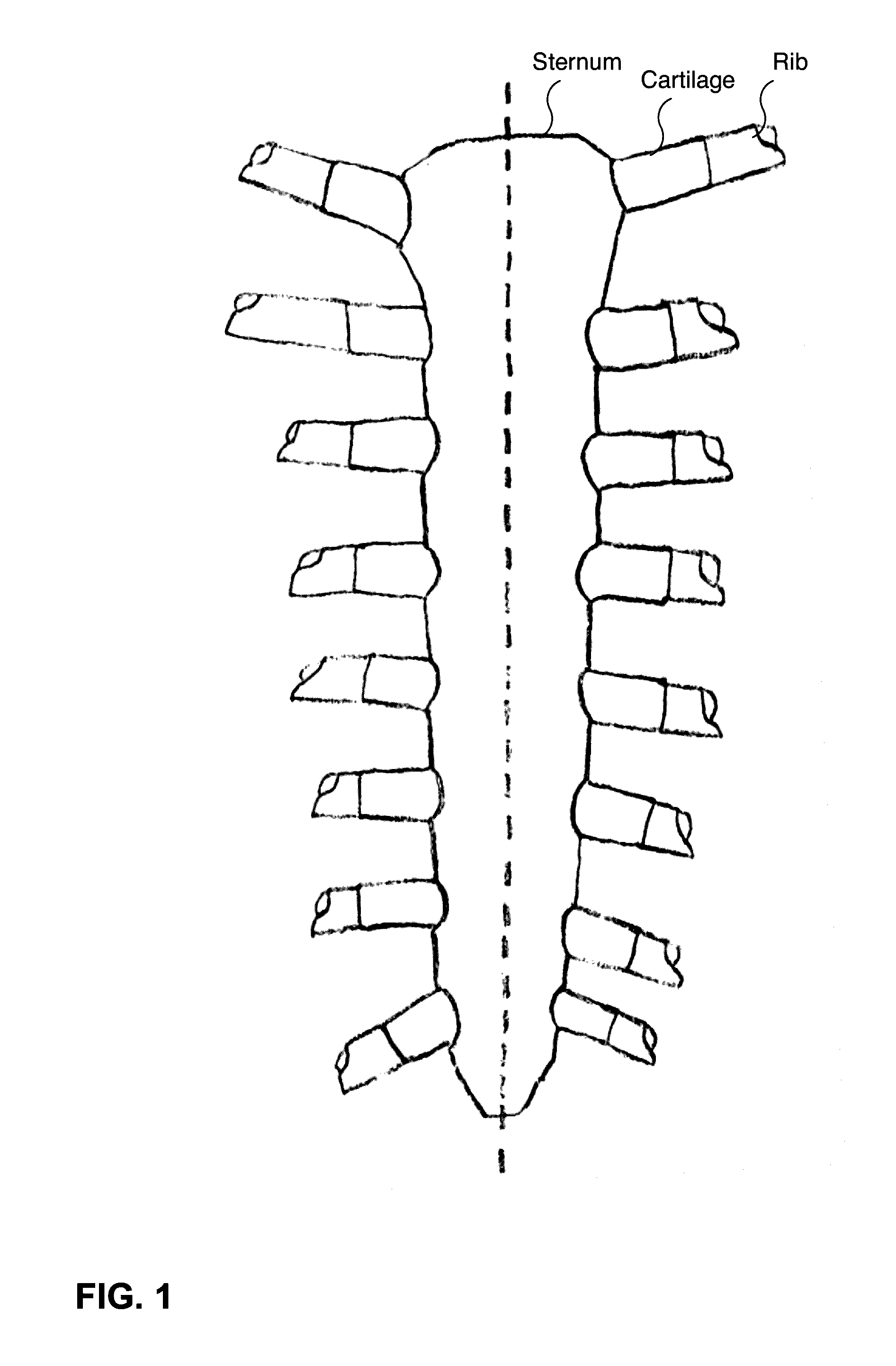 Sternal osteotomy guide and sternal fixation system