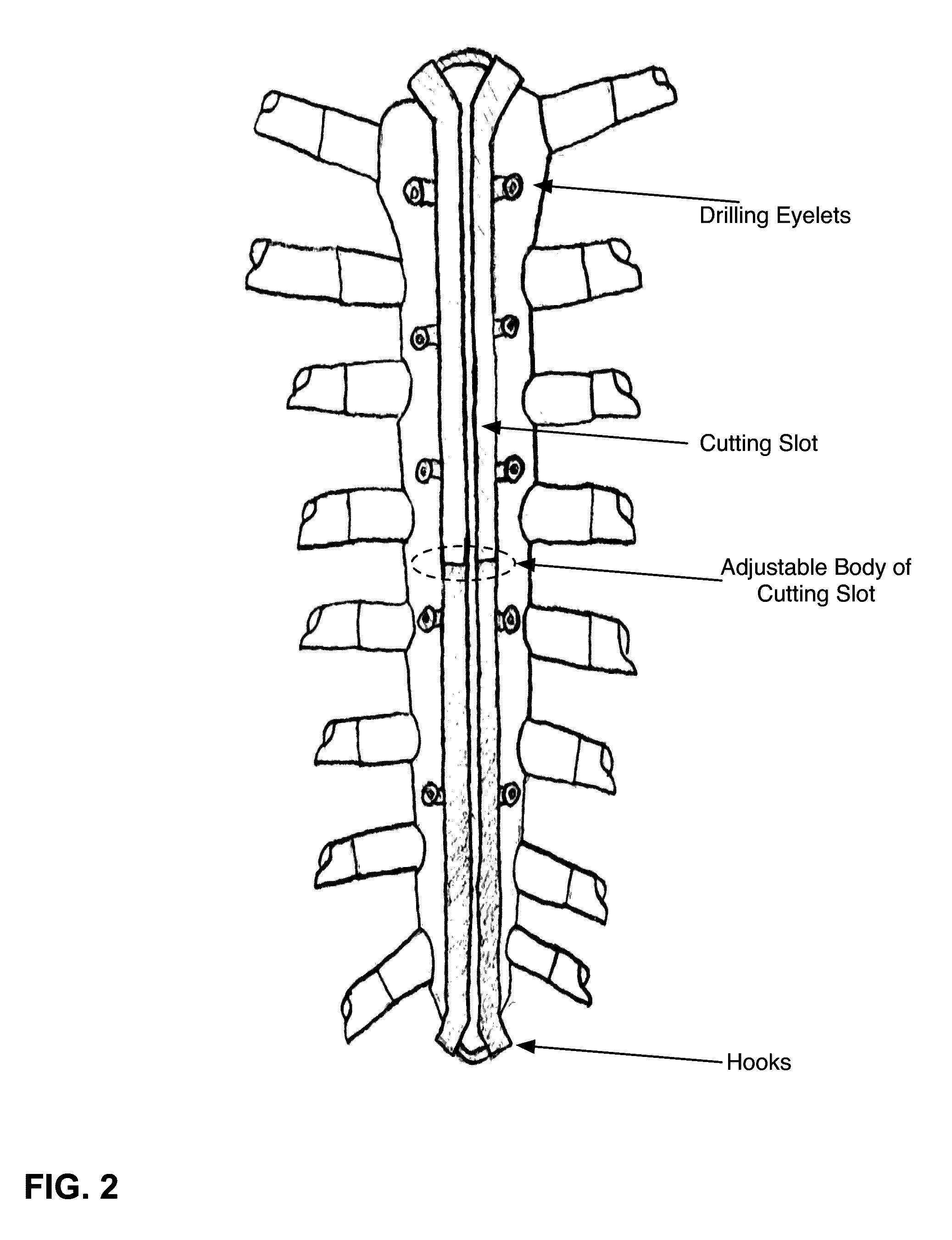 Sternal osteotomy guide and sternal fixation system