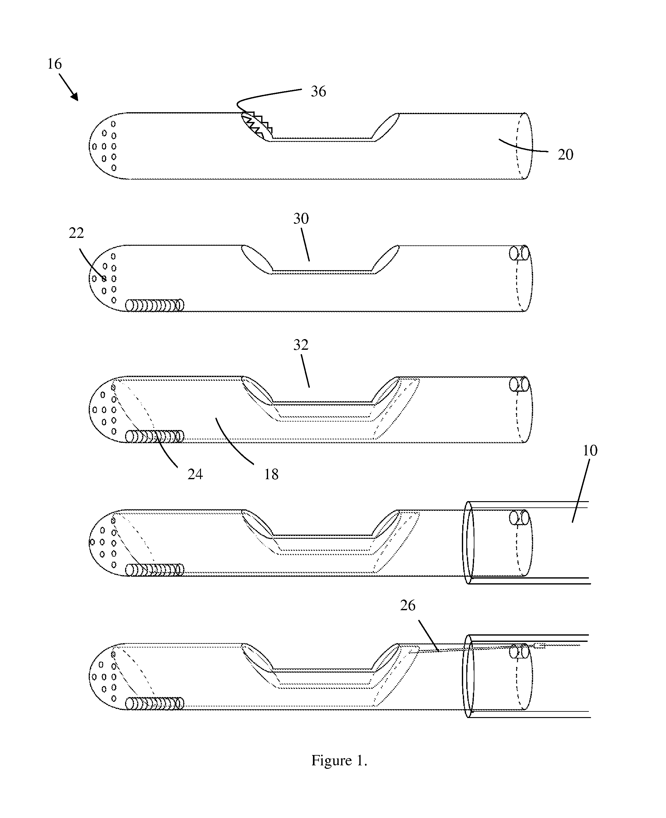 Method and device for the treatment of hypertrophic cardiomyopathy