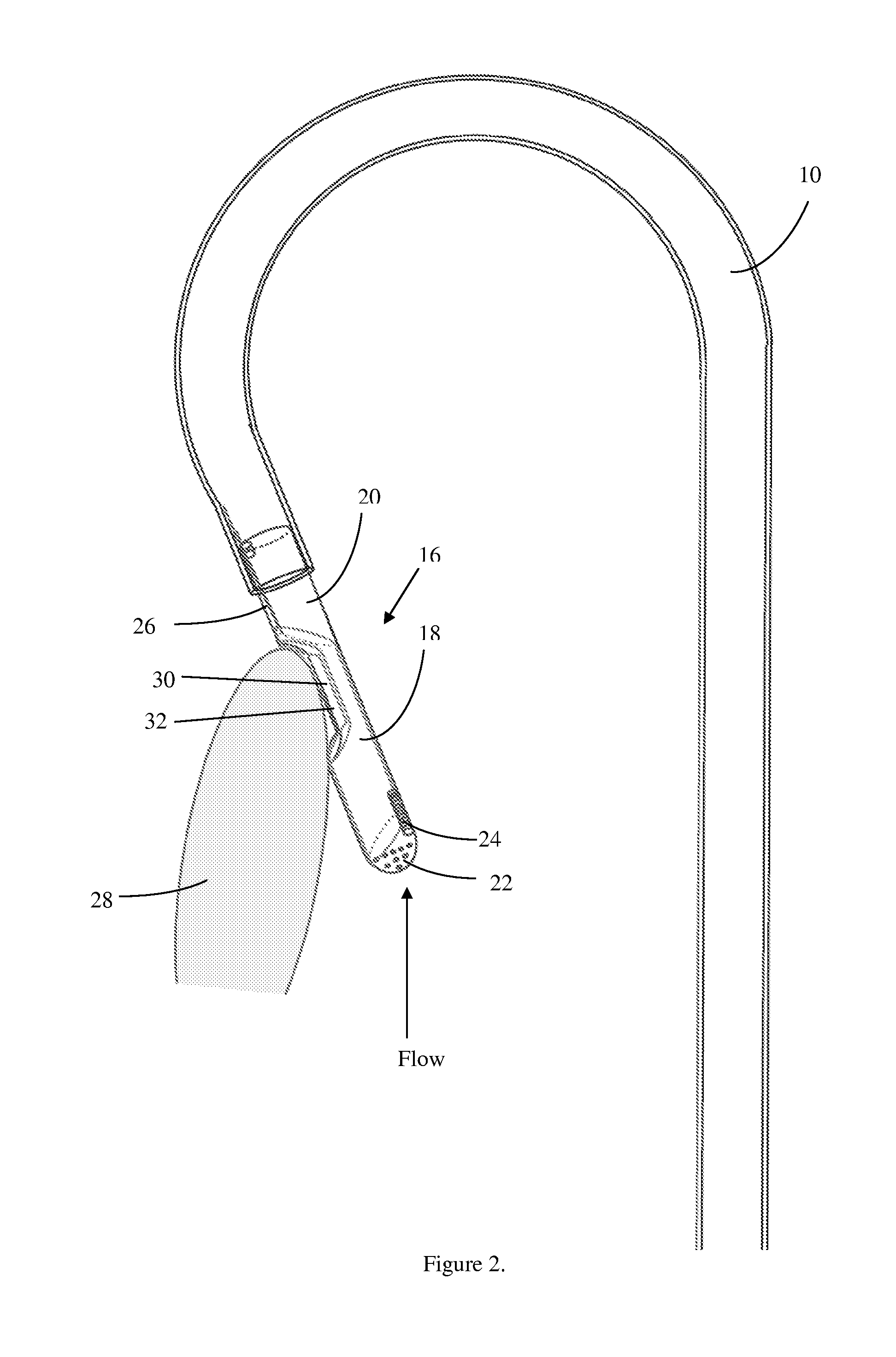 Method and device for the treatment of hypertrophic cardiomyopathy