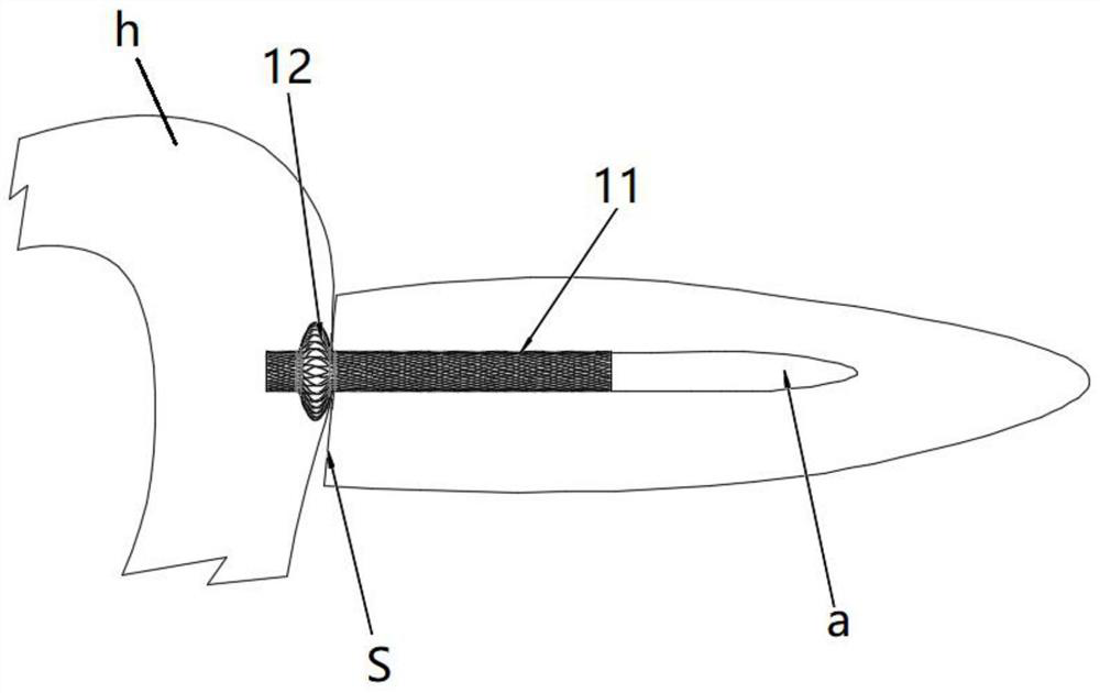 Self-expanding stent for pancreaticojejunostomy