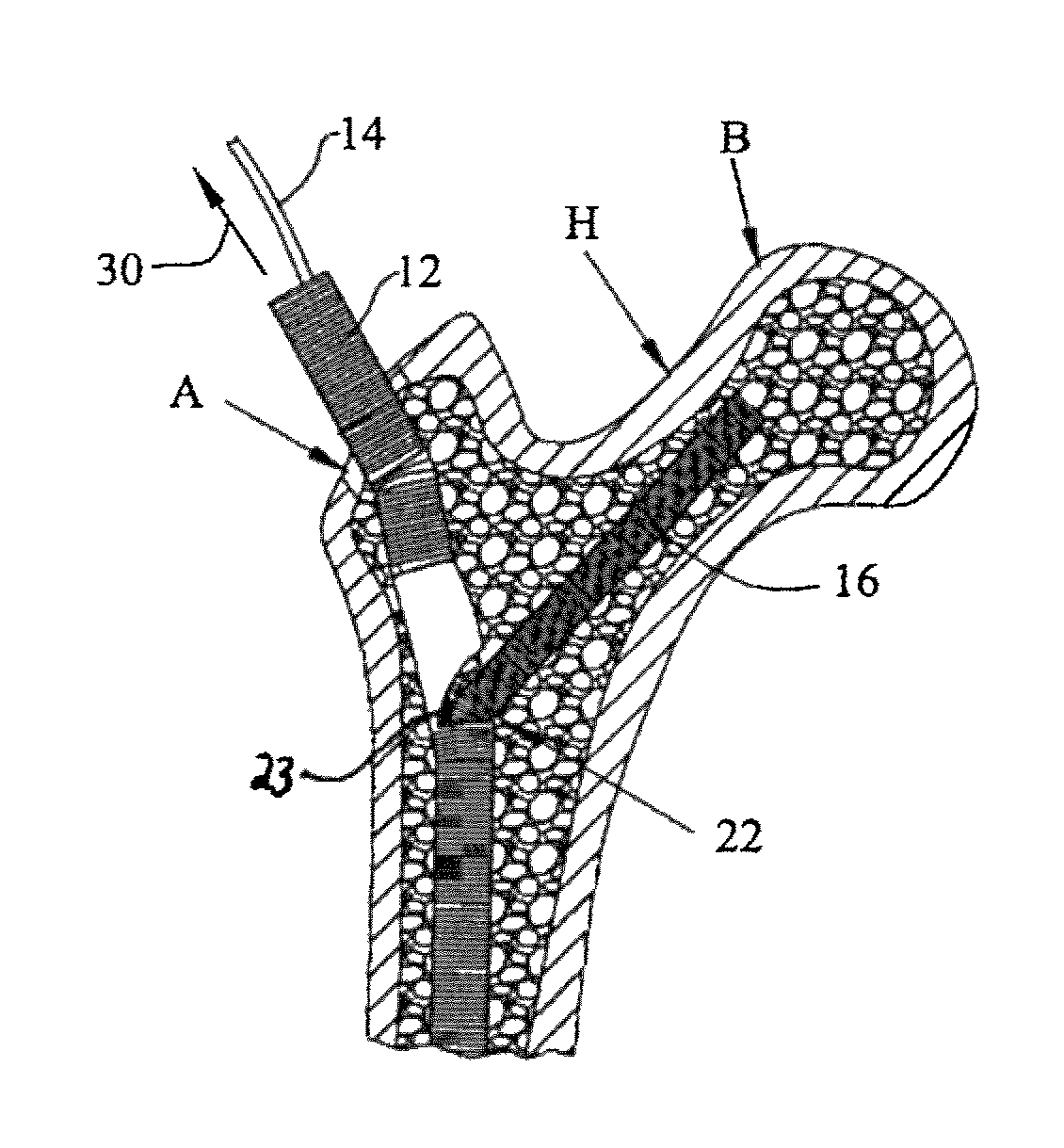 Apparatus and method for prophylactic hip fixation