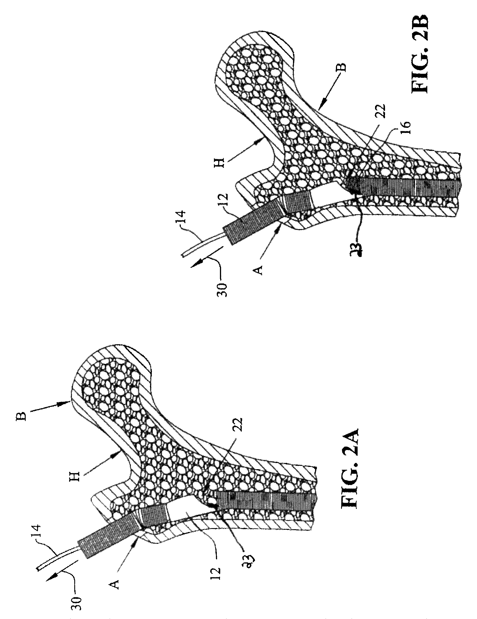 Apparatus and method for prophylactic hip fixation