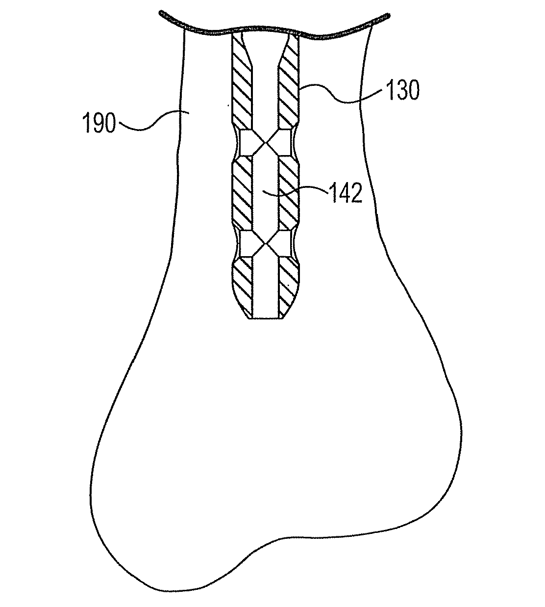 Intermedullary system and method