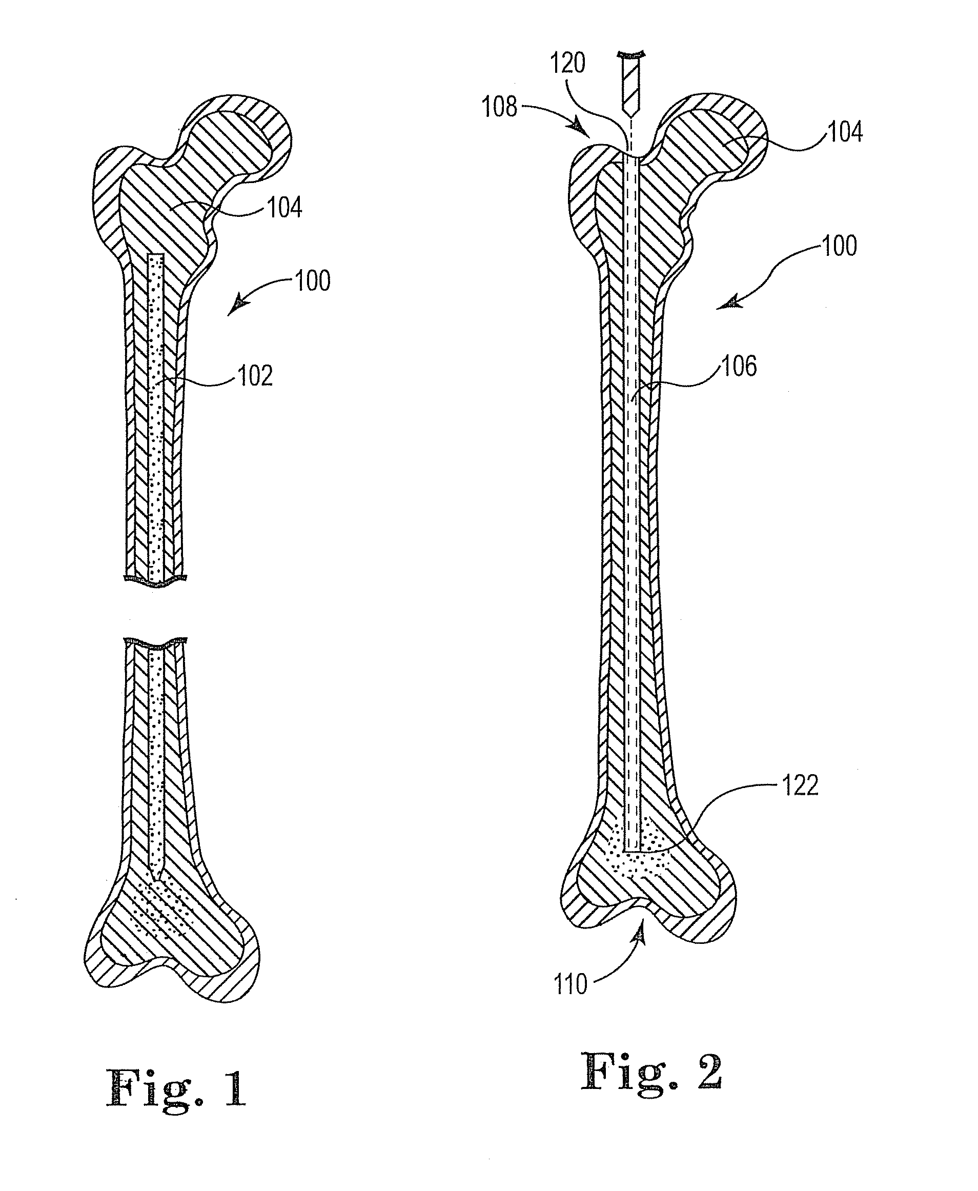 Intermedullary system and method