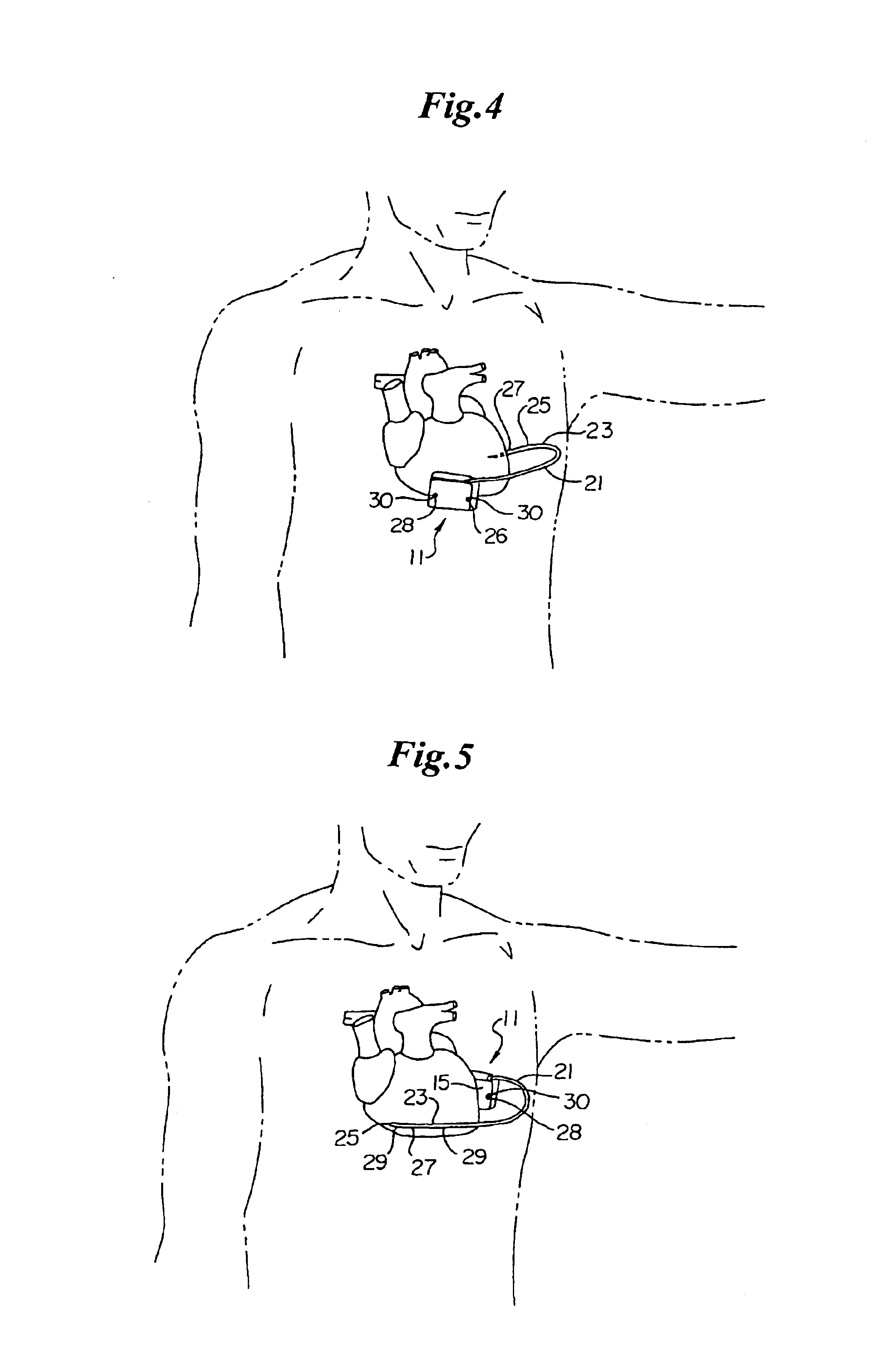 Subcutaneous electrode for transthoracic conduction with low-profile installation appendage and method of doing same