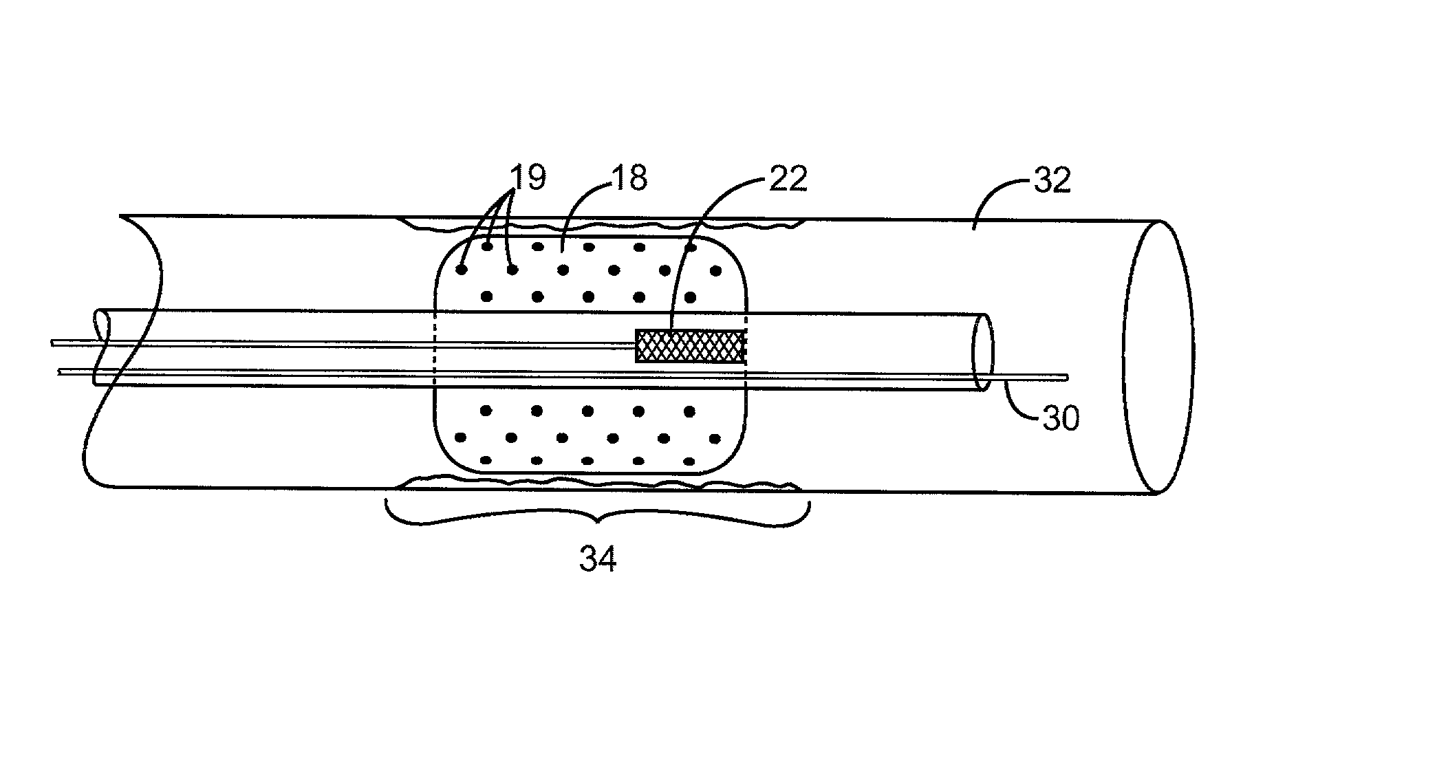 Combination x-ray radiation and drug delivery devices and methods for inhibiting hyperplasia