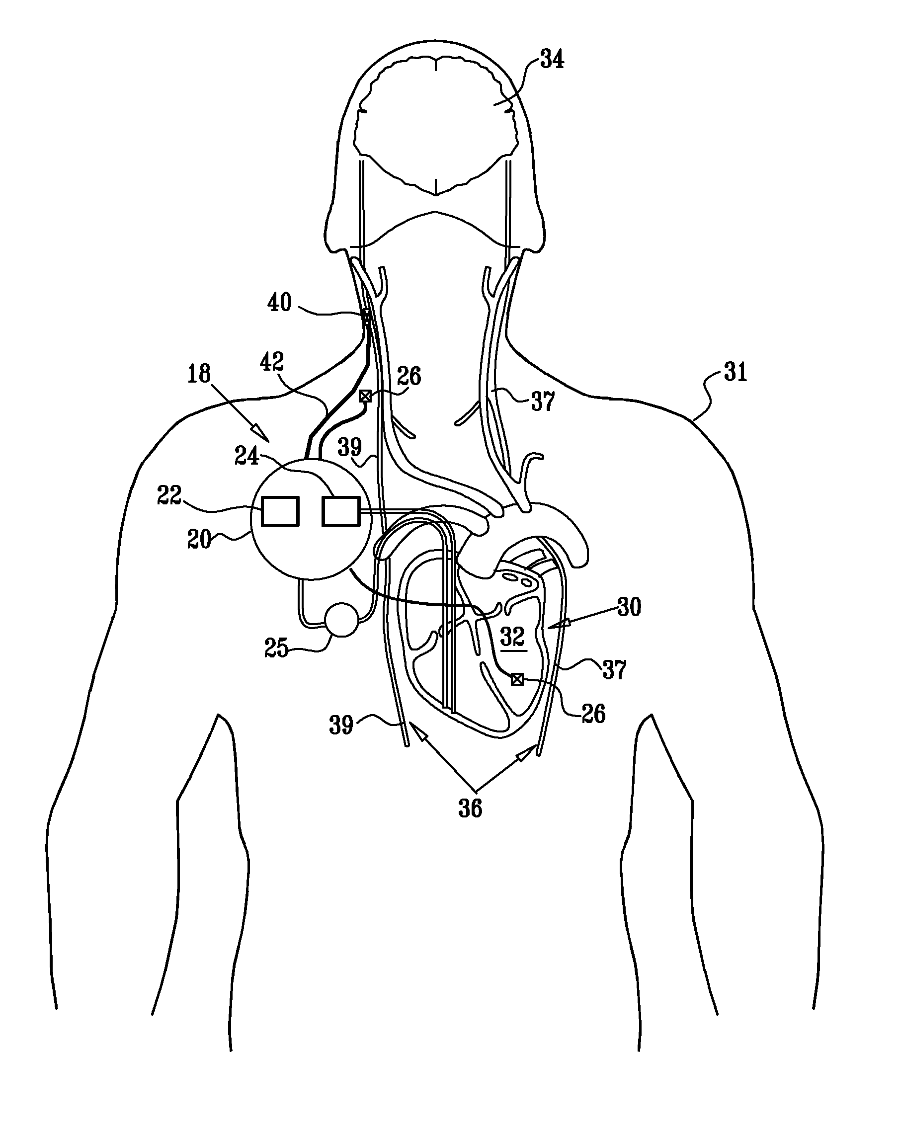 Nerve stimulation techniques