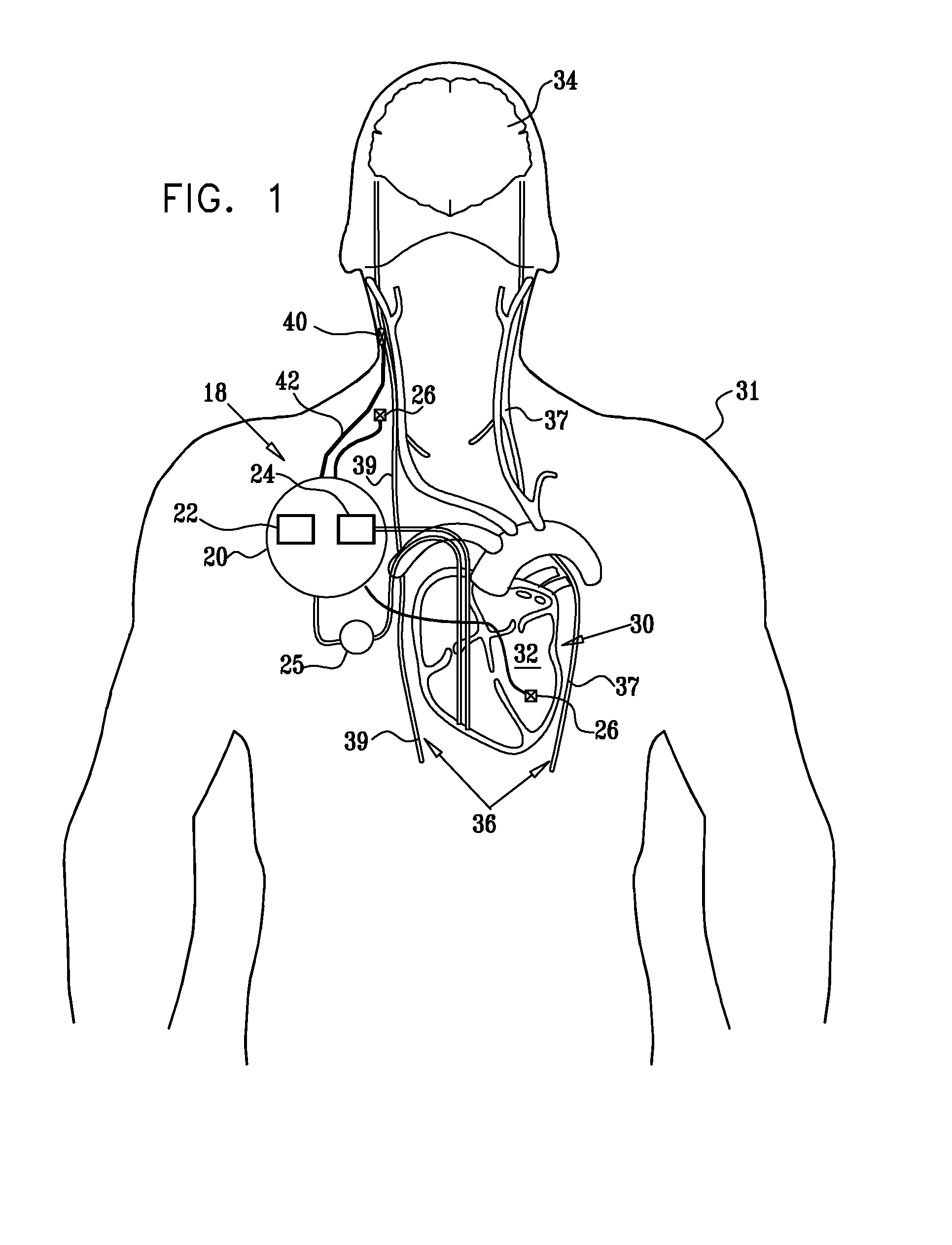 Nerve stimulation techniques