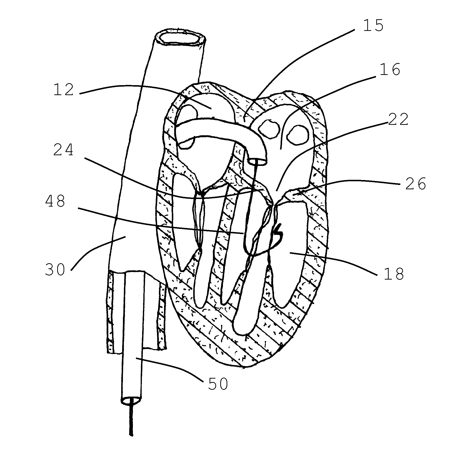 Method for implanting prosthetic valve