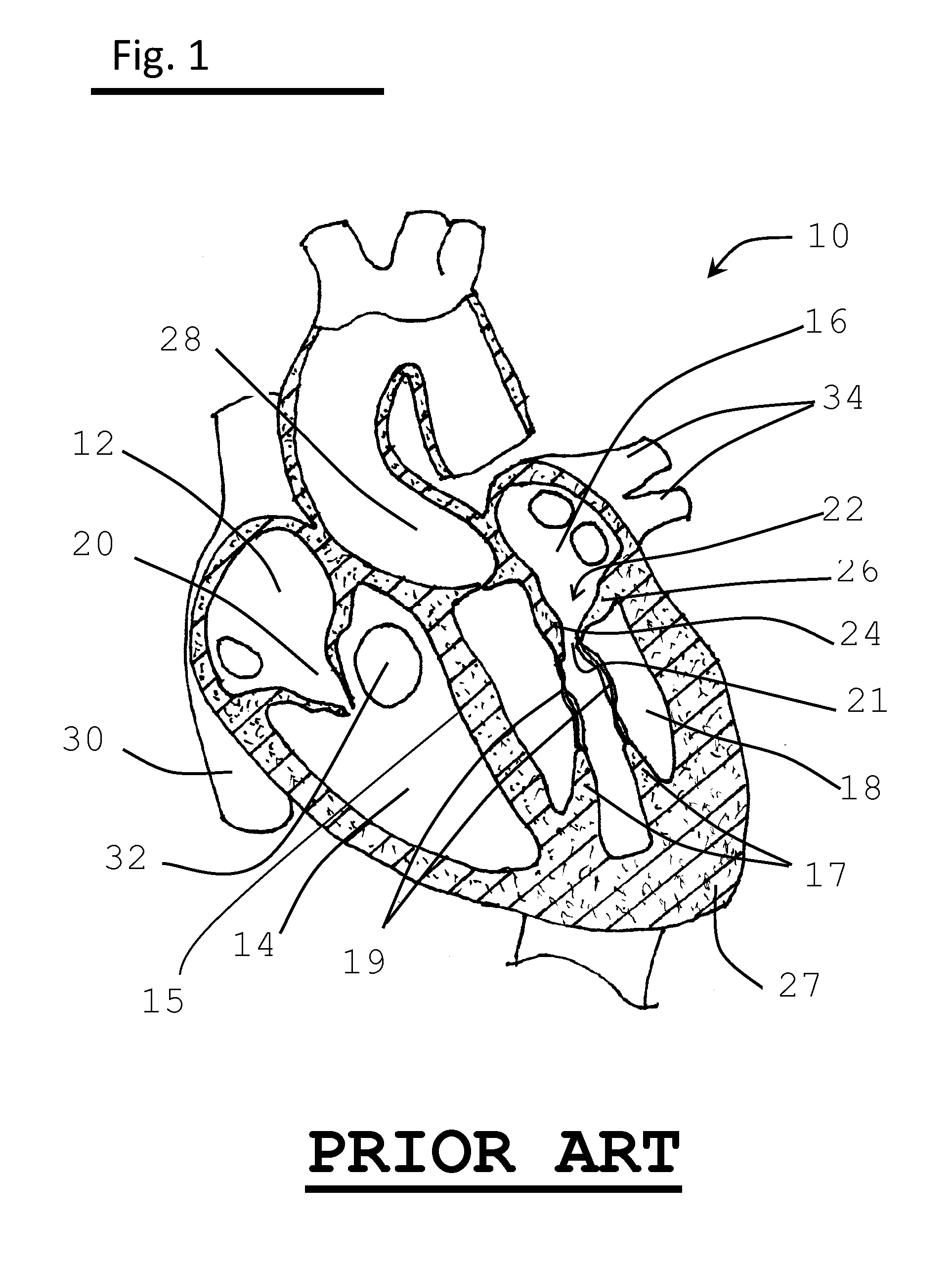 Method for implanting prosthetic valve