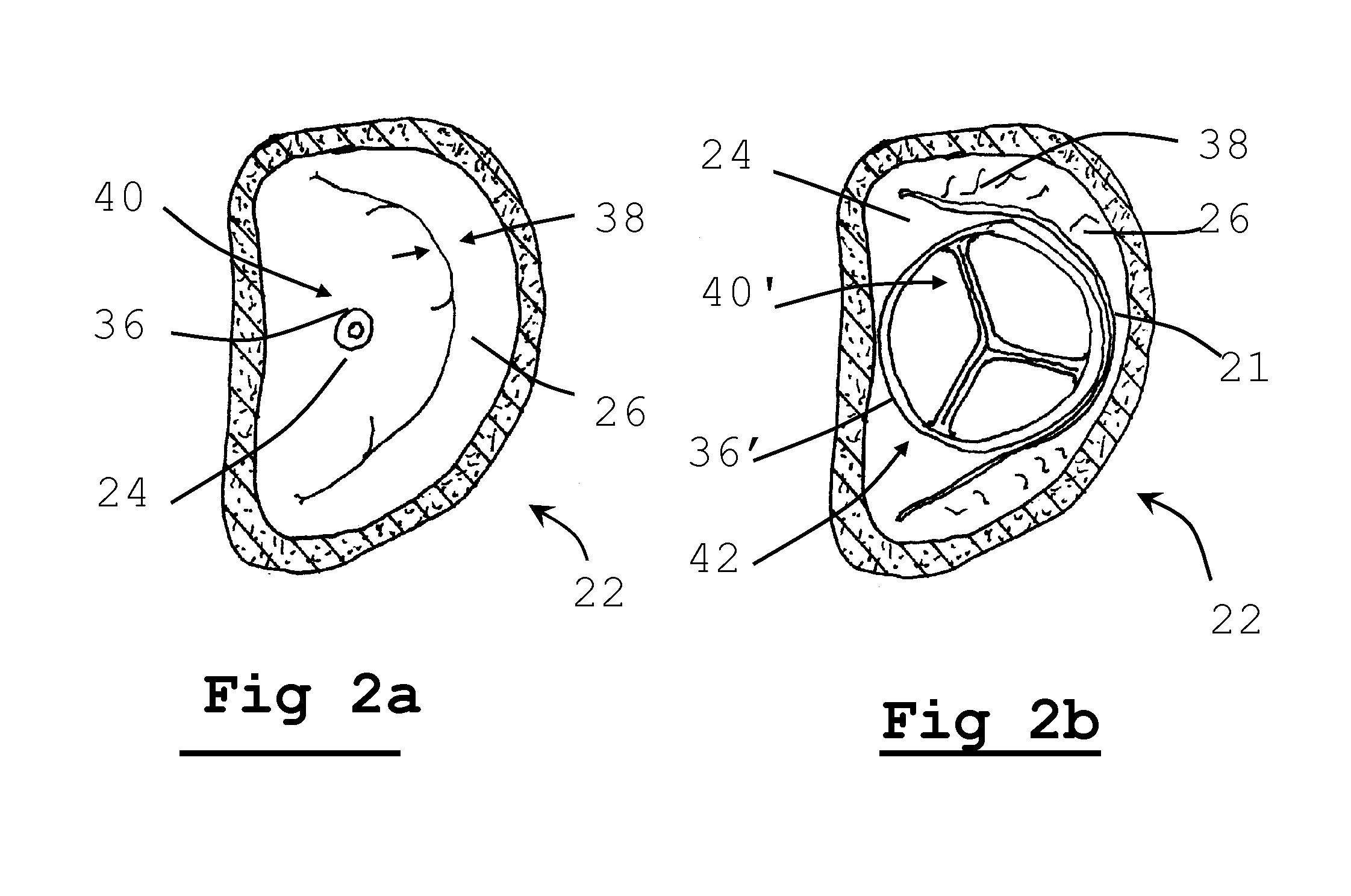 Method for implanting prosthetic valve