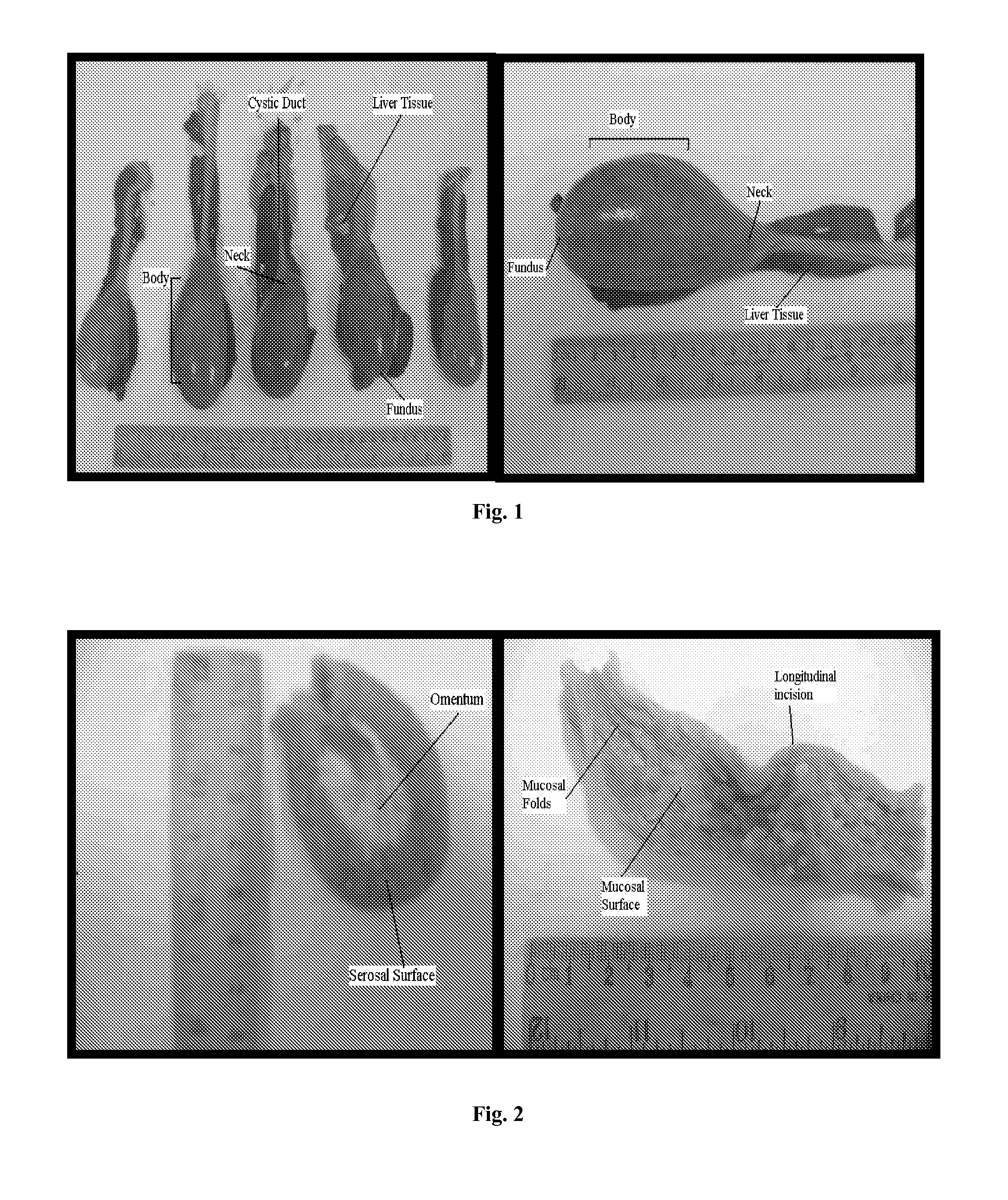 Tissue graft scaffold made from cholecyst-derived extracellular matrix