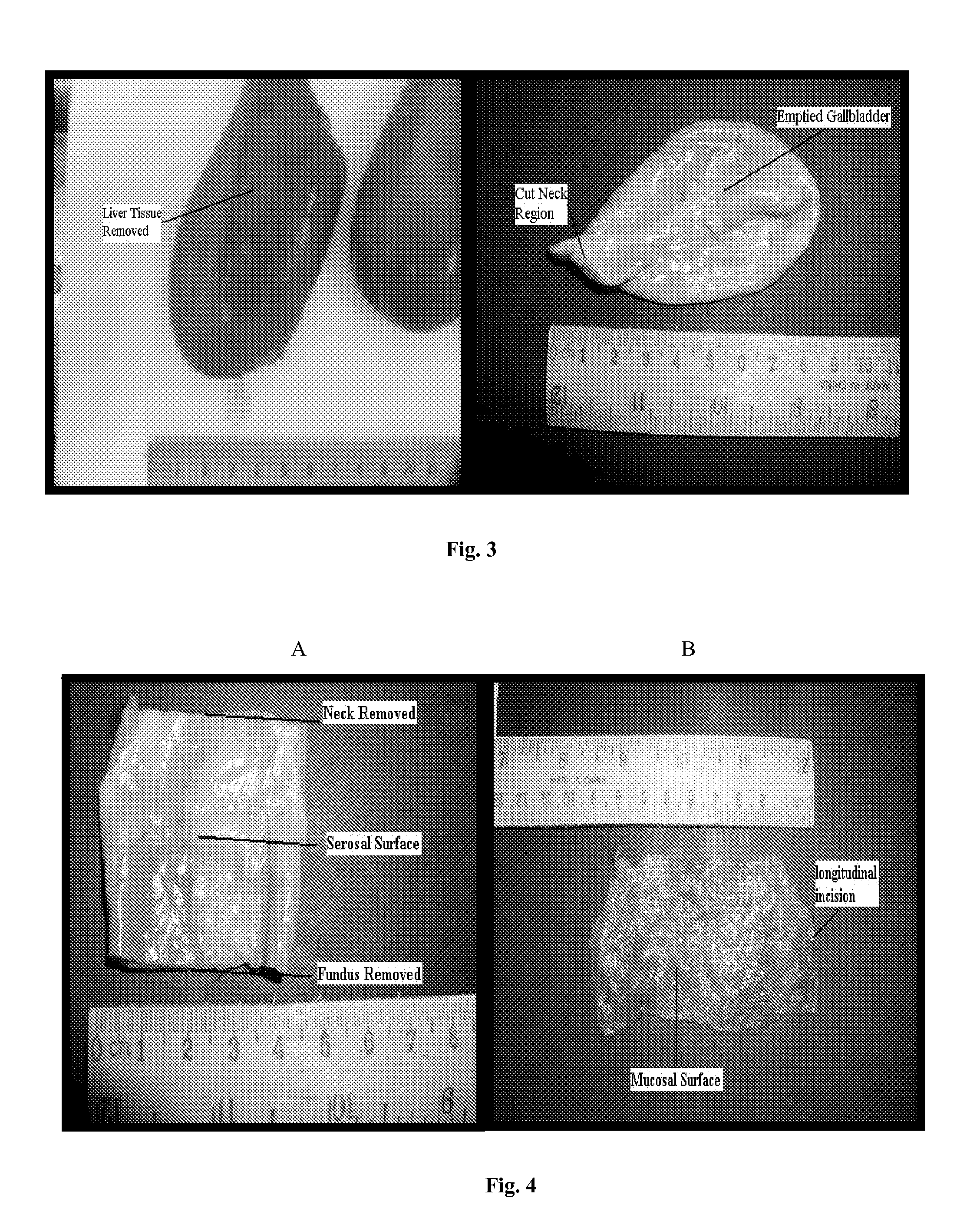 Tissue graft scaffold made from cholecyst-derived extracellular matrix