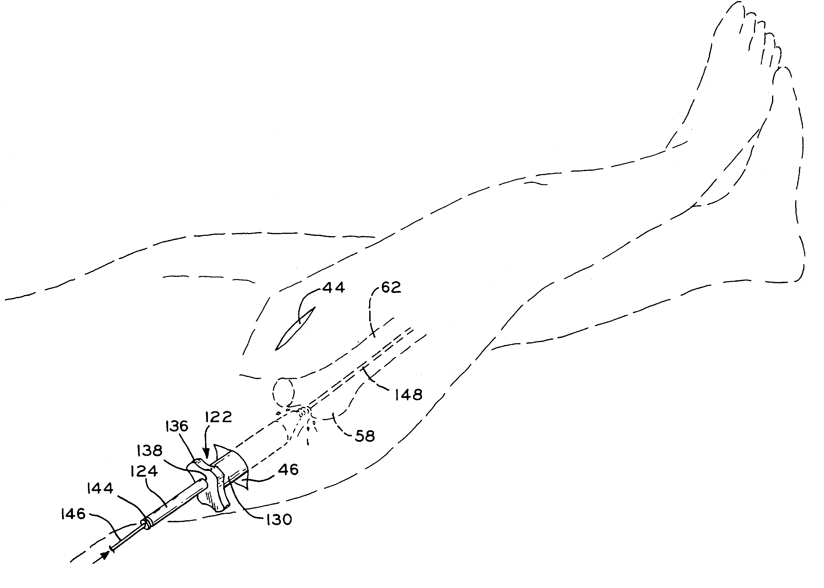 Method and apparatus for performing a minimally invasive total hip arthroplasty