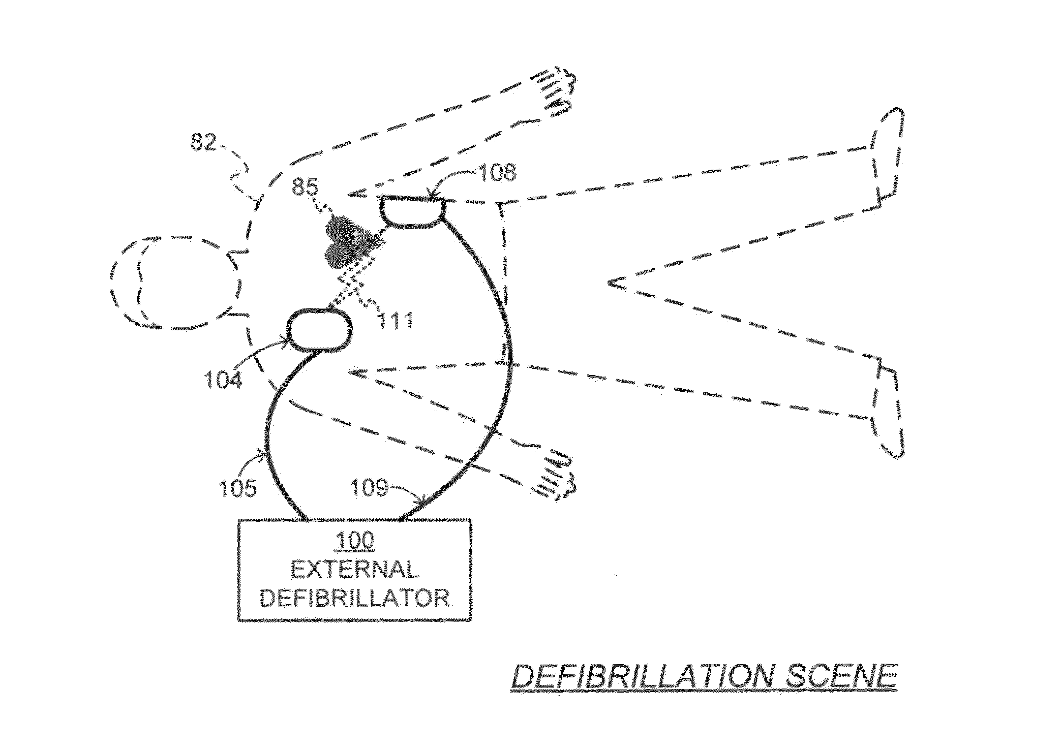 Filtering patient signal also for ventilation artifacts