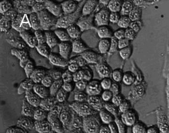 Method for preparing medicament-nanometer calcium phosphate composite system taking fat soluble photosensitizer as framework and application of system in preparation of medicaments for photodynamic therapy