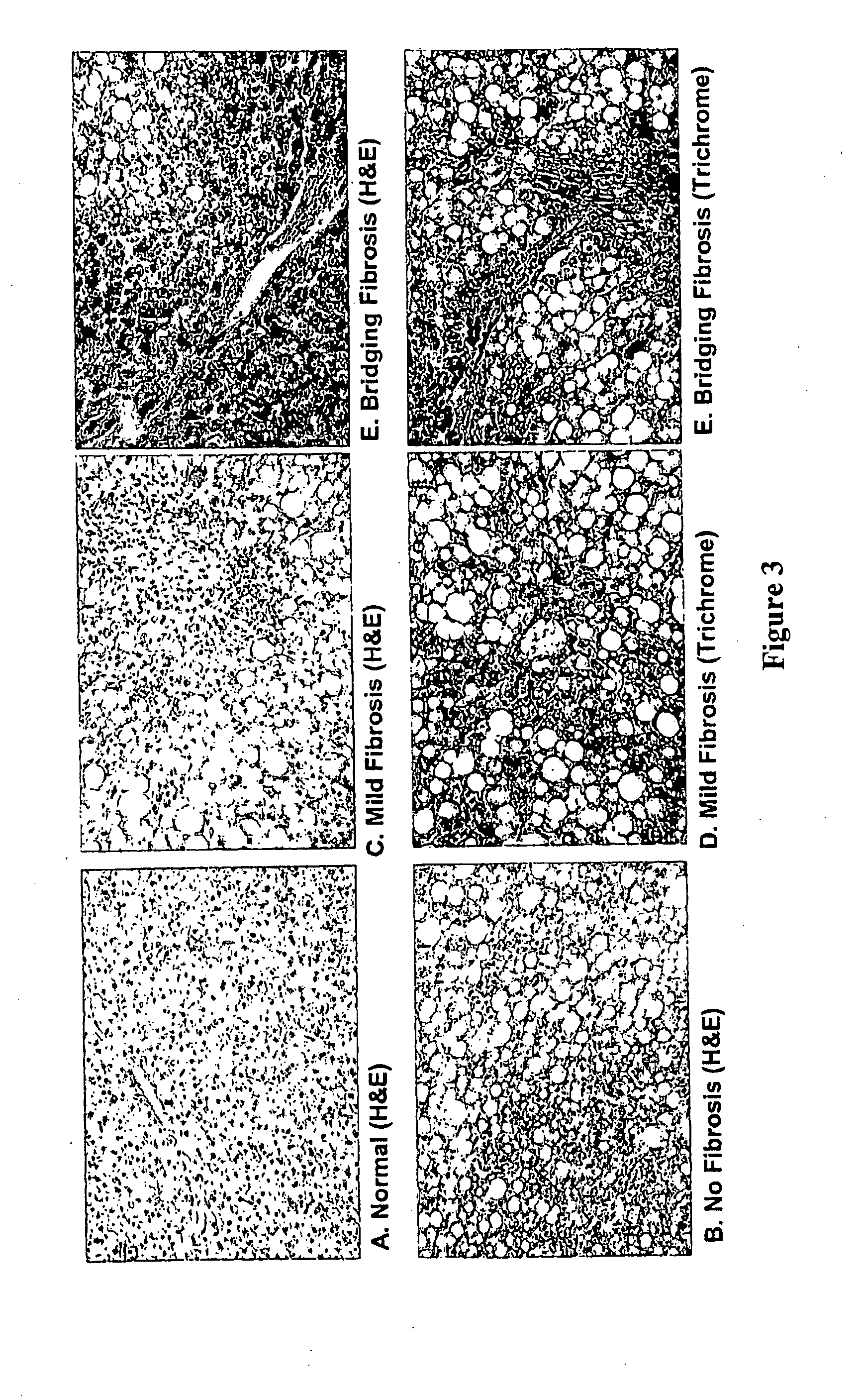 Methods for diagnosing and predicting non-alcoholic steatohepatitis (NASH)