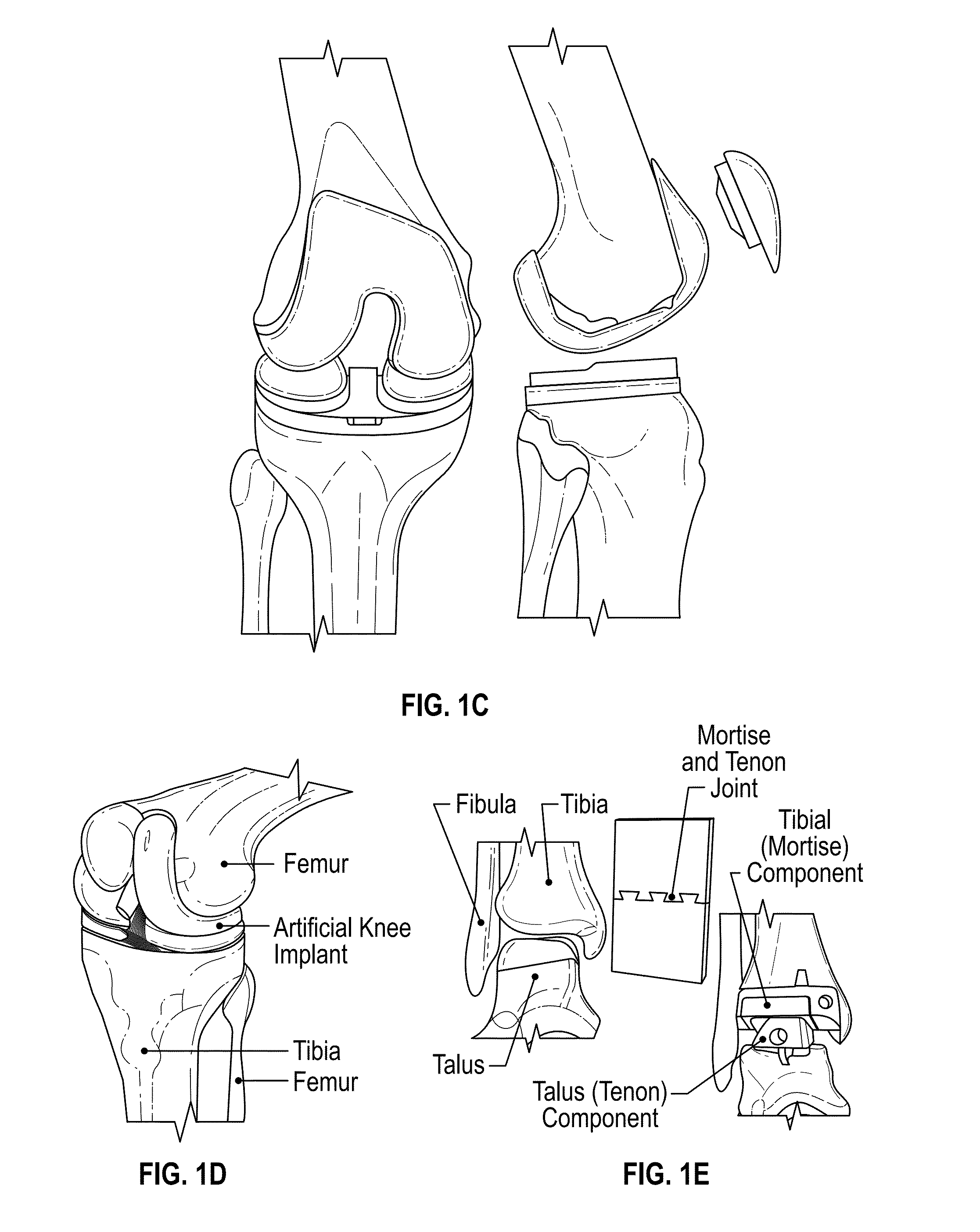 Joint Replacement or Joint Resurfacing Devices, Systems and Methods