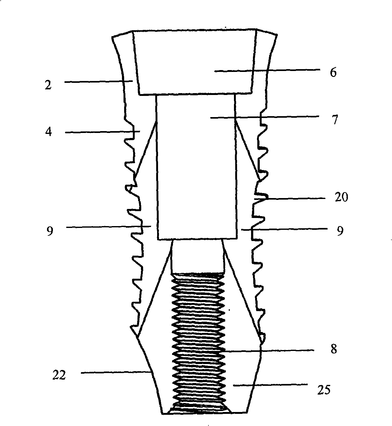 Bionics tooth planting body and implantation method thereof