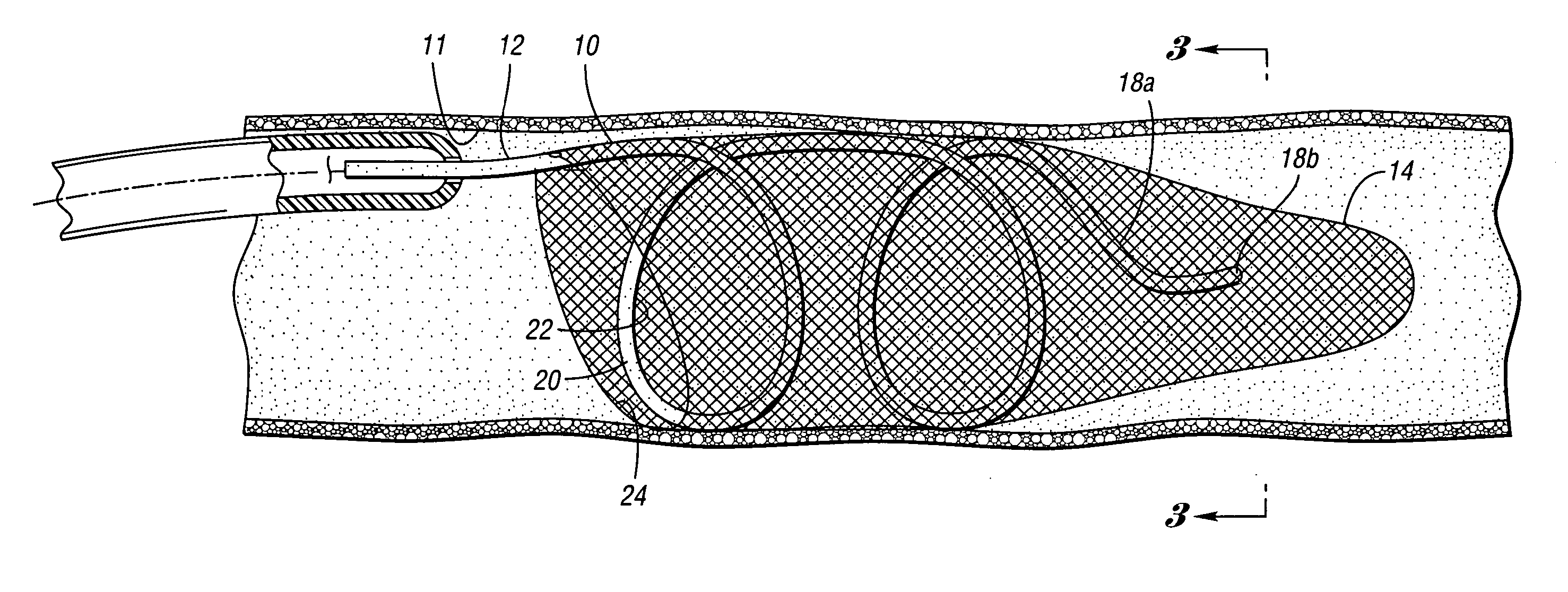 Embolic protection device having inflatable frame