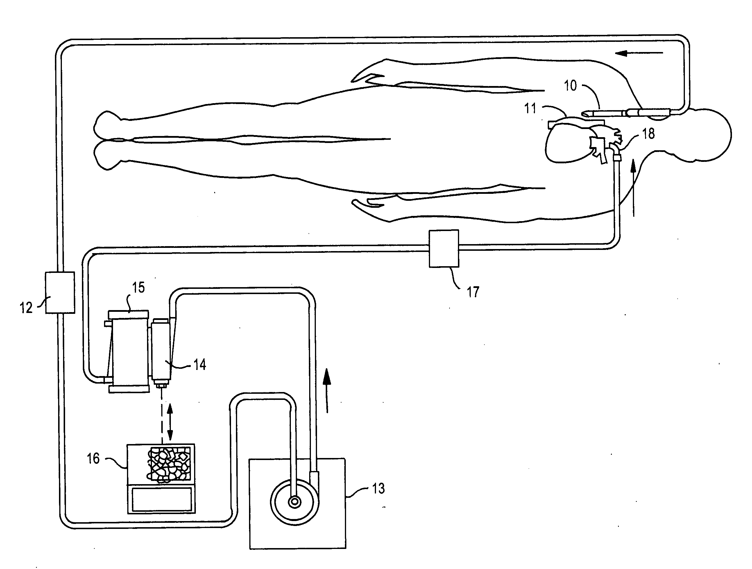 Air removal device with float valve for blood perfusion system