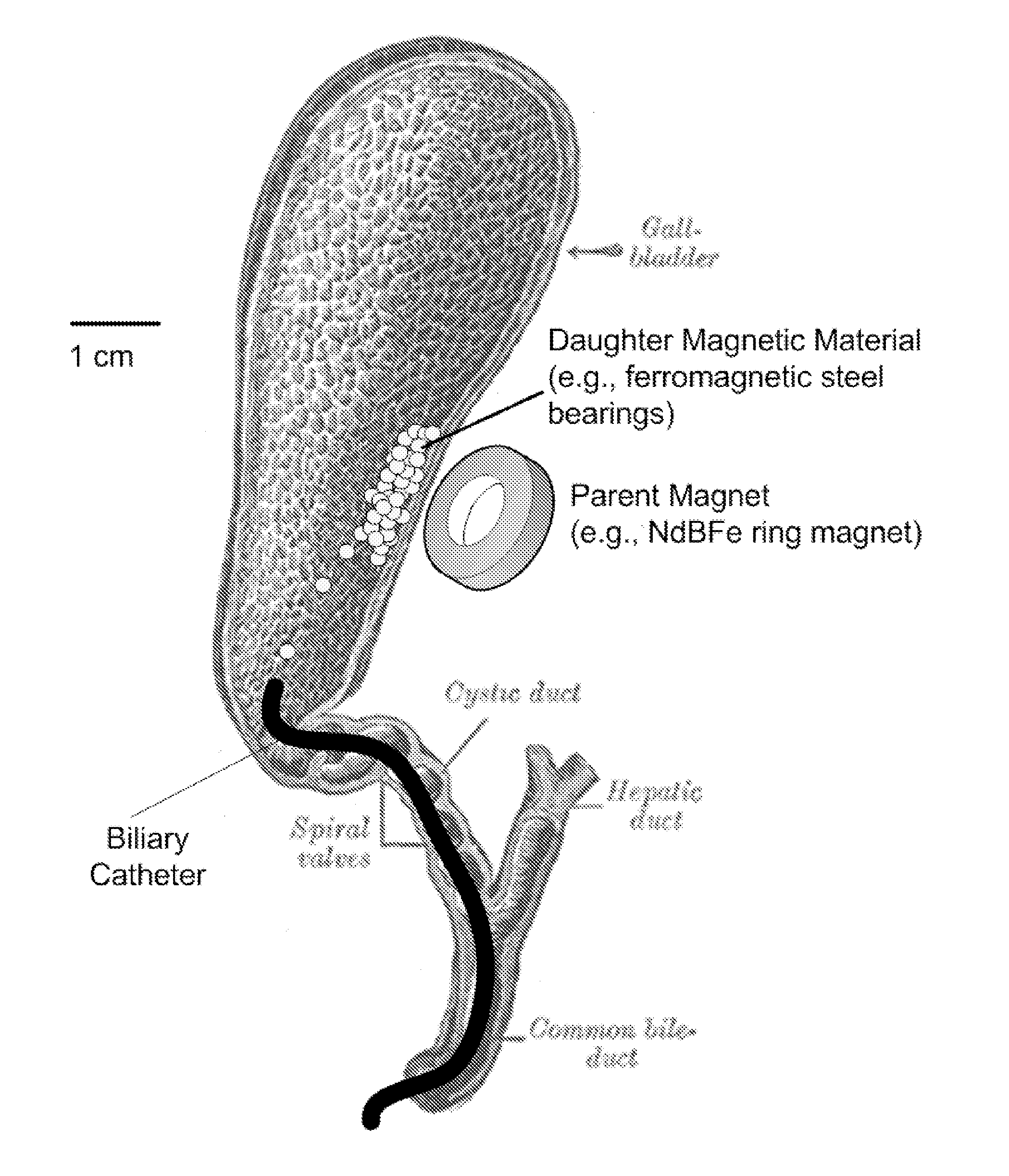 Methods and apparatus for magnet-induced compression anastomosis between adjacent organs