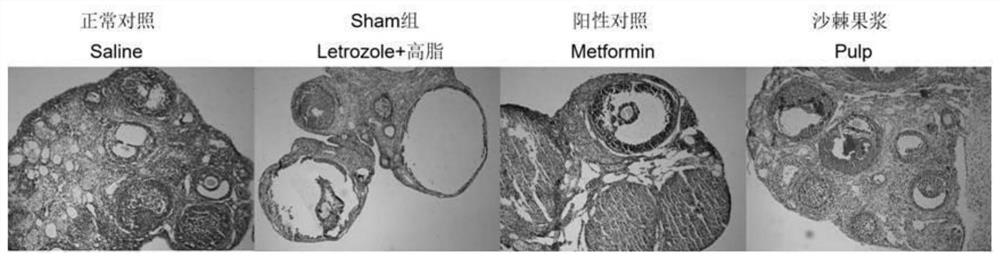 Application of seabuckthorn pulp in the treatment of polycystic ovary syndrome