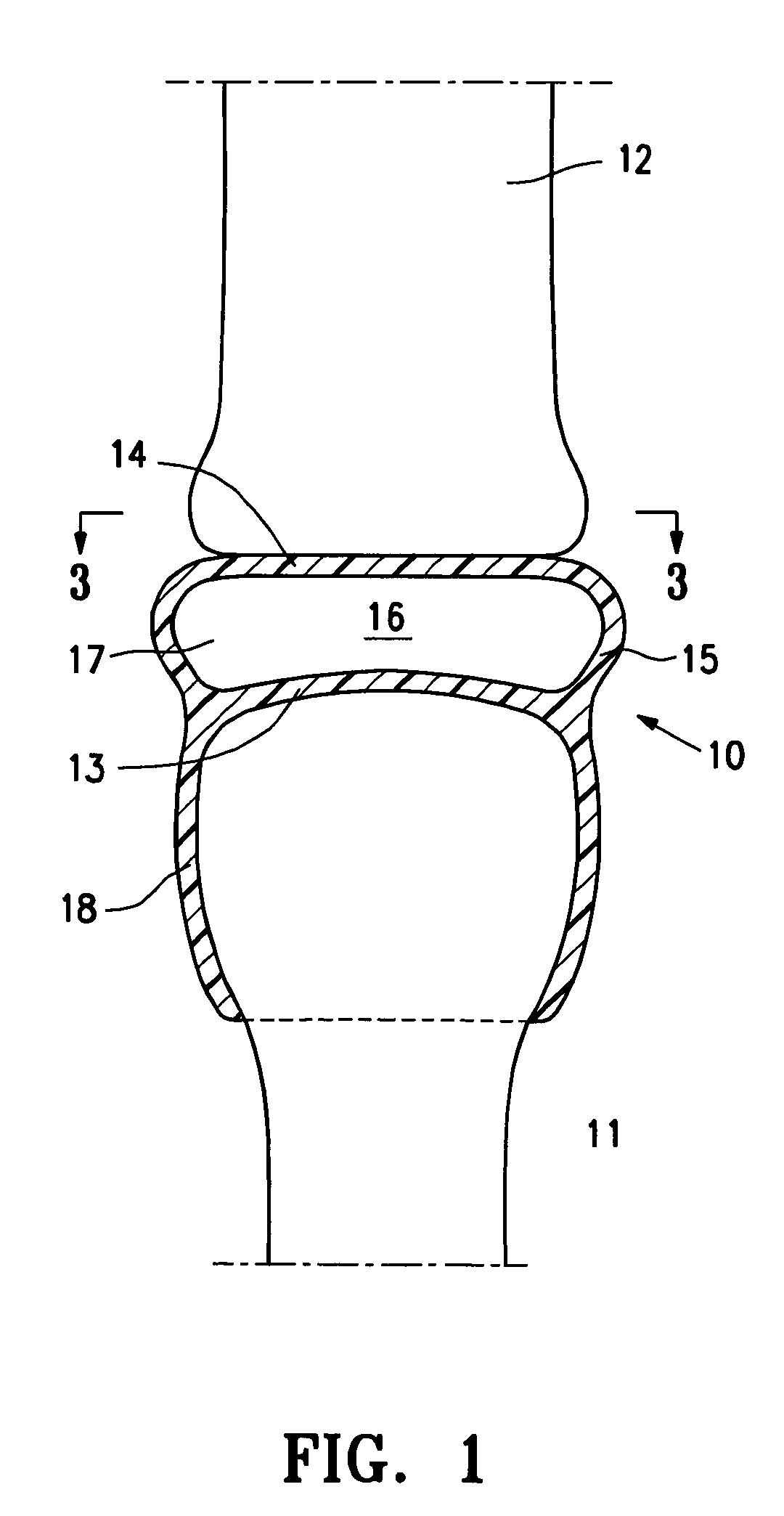 Resilient arthroplasty device