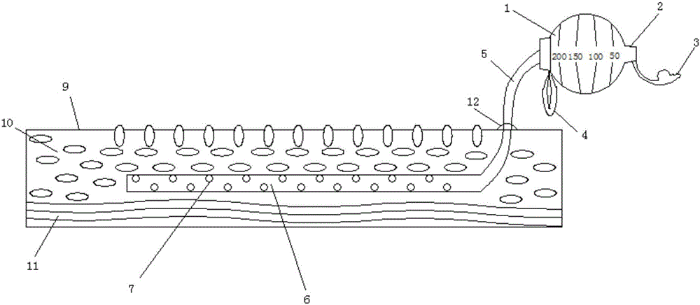 Subcutaneous negative pressure drainage apparatus for abdominal incision