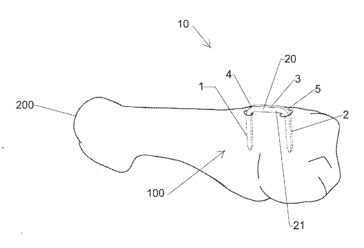 Elastic orthopedic implant and method of manufacturing thereof