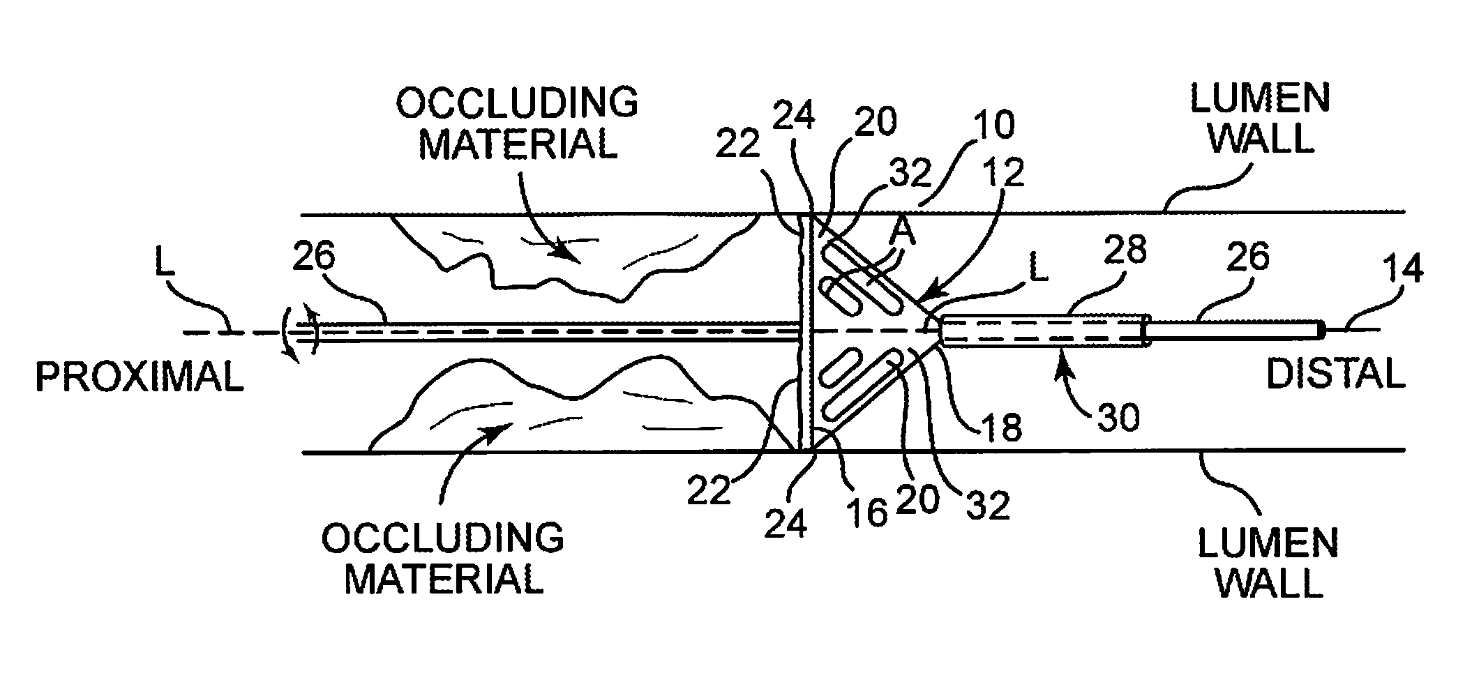 Cutting and coring atherectomy device and method