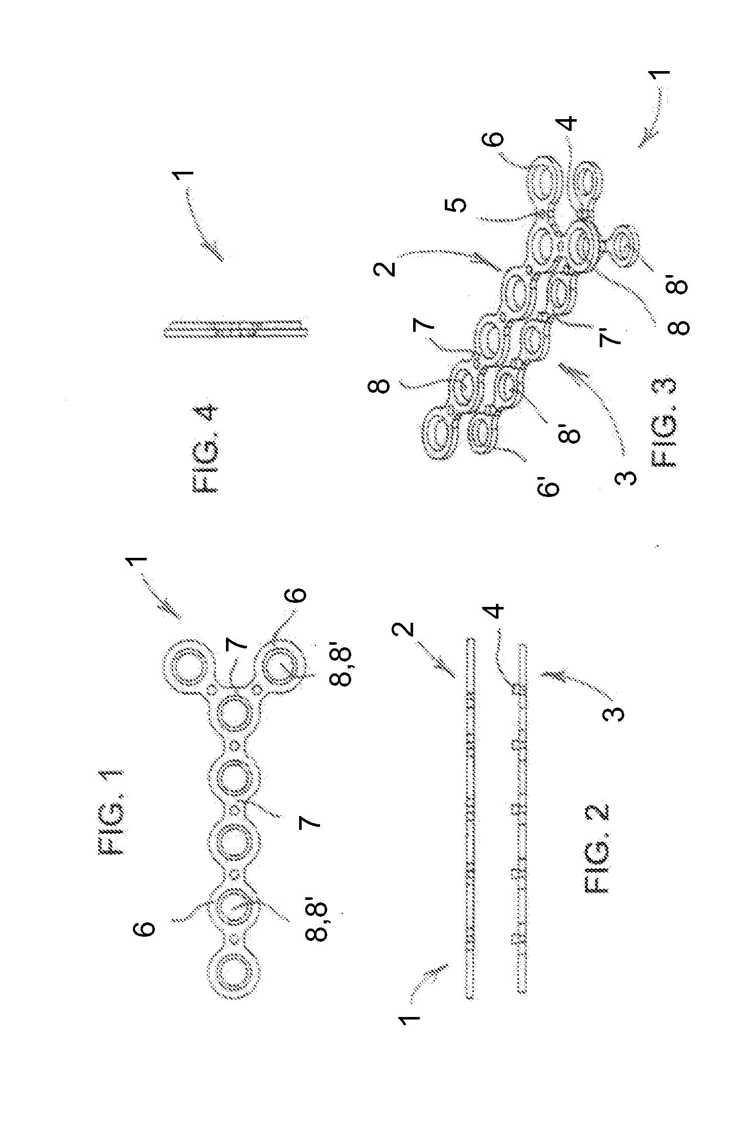 Hybrid Orthopedic Implant