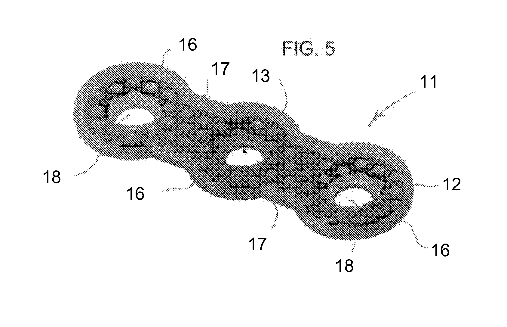 Hybrid Orthopedic Implant