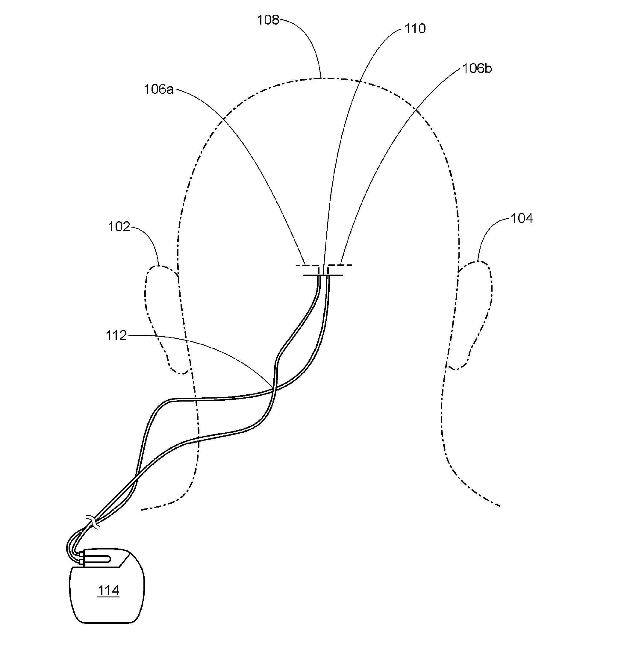 Occipital neuromodulation